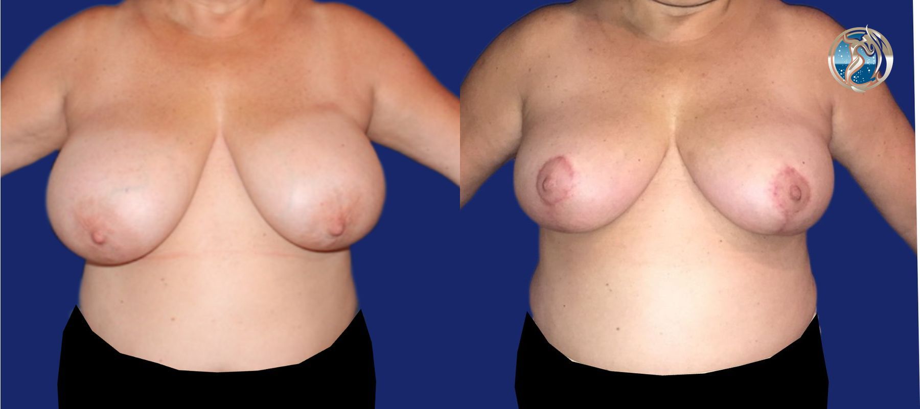Before and after Breast Reduction case 46063