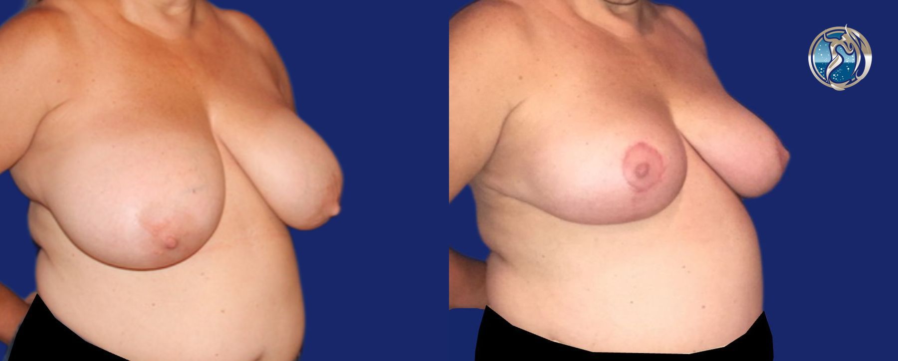 Before and after Breast Reduction case 46063 - Angle 2