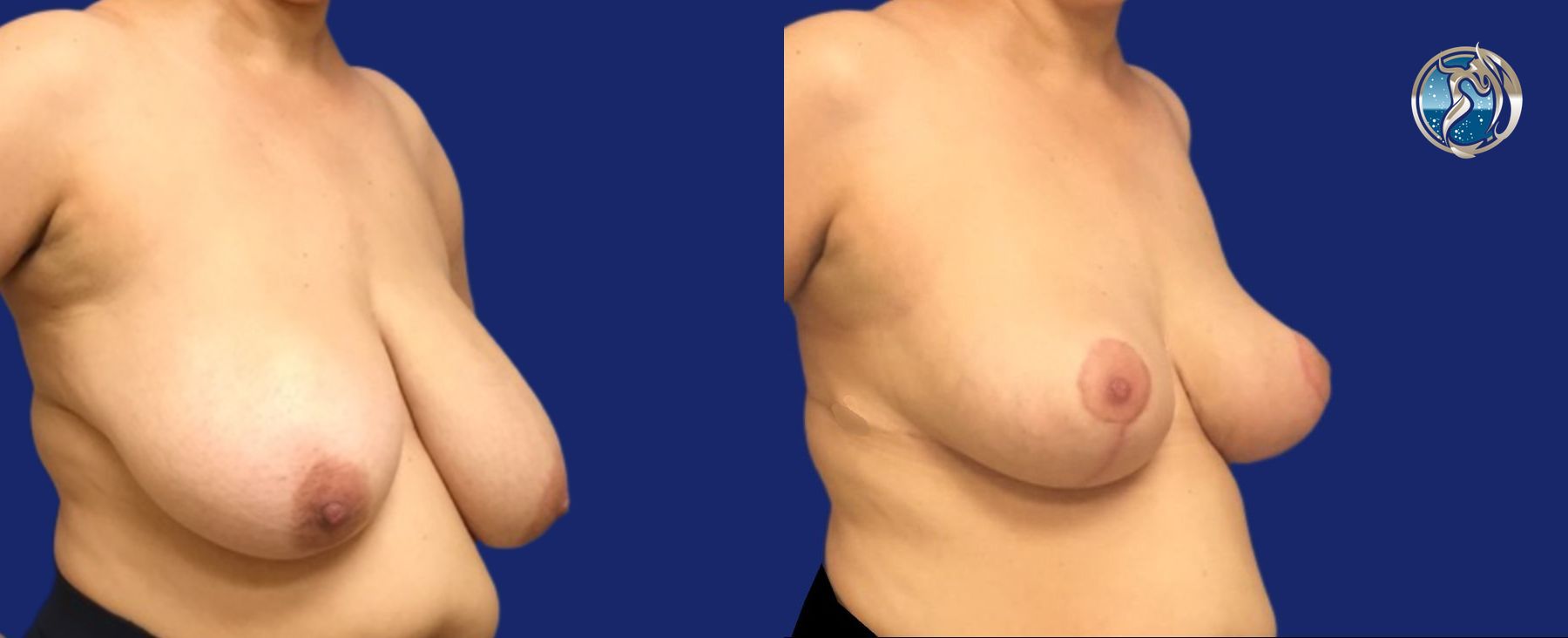 Before and after Breast Reduction case 46106 - Angle 3