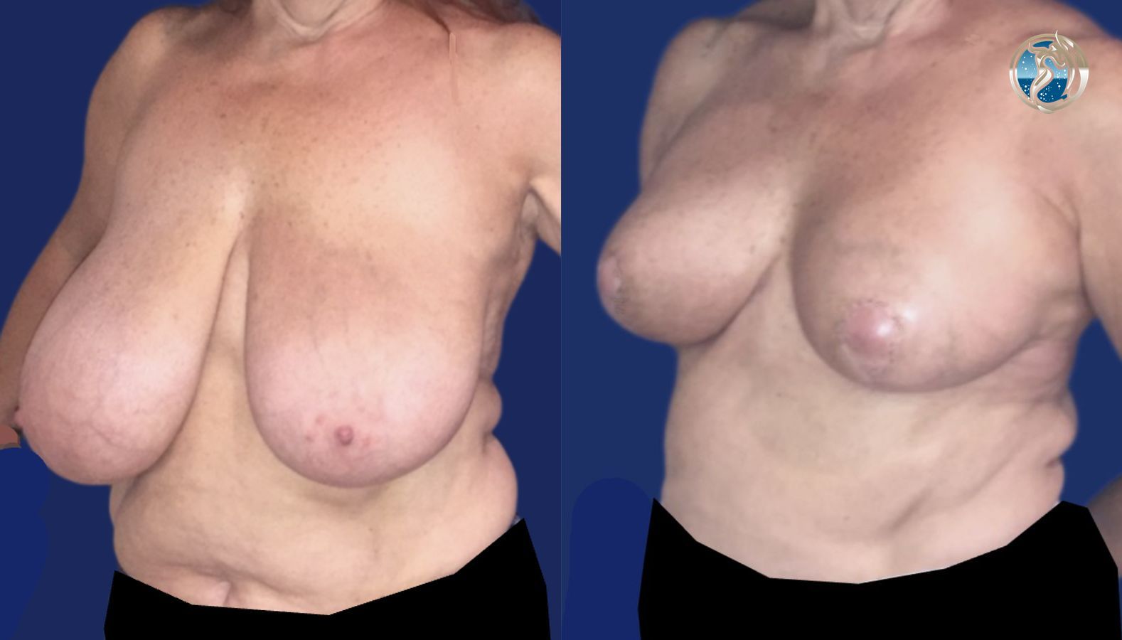 Before and after Breast Reduction case 46110 - Angle 5