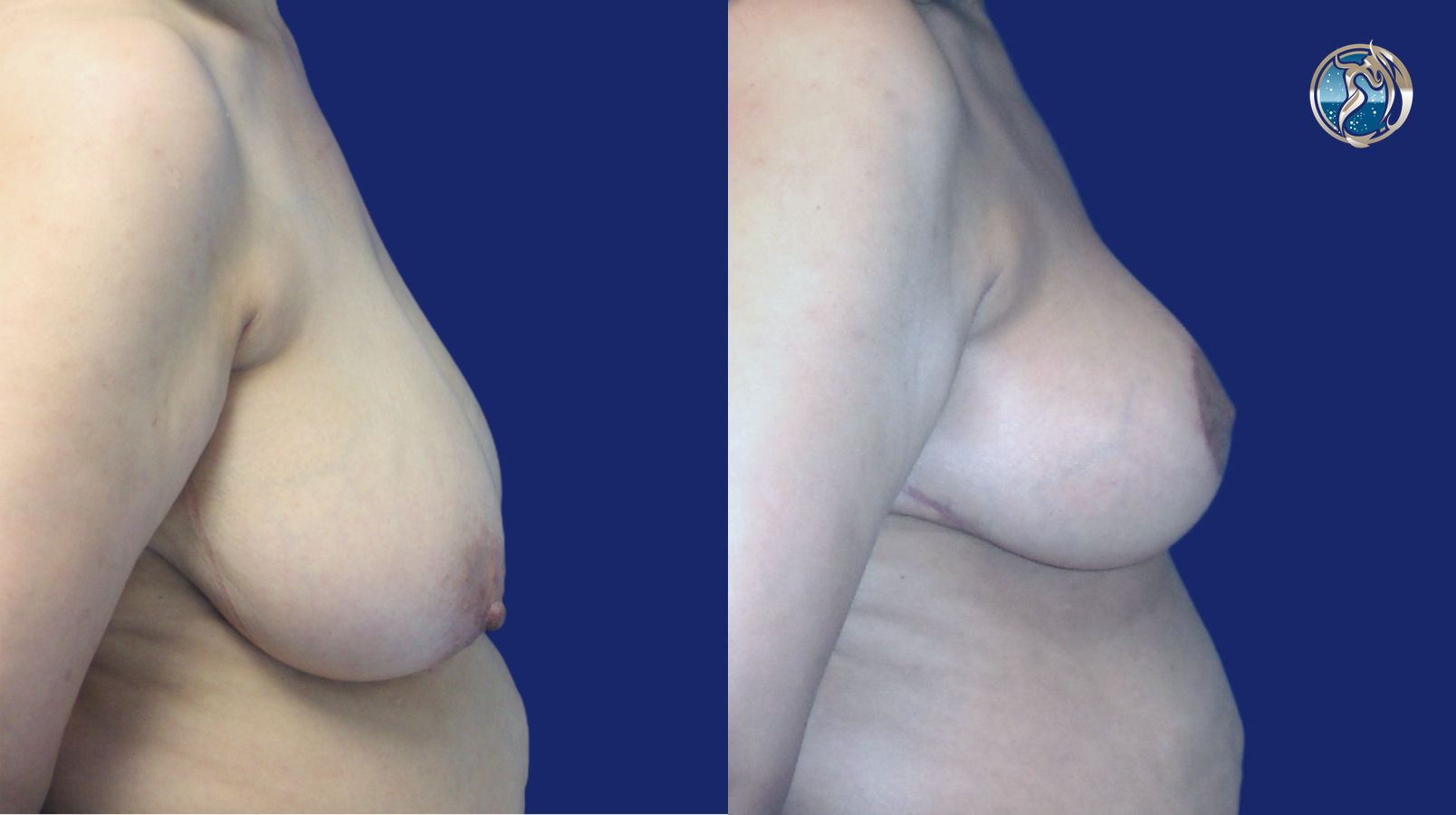 Before and after photo set of Breast Reduction by Dr. Orna Fisher in San Mateo, CA - Angle 5