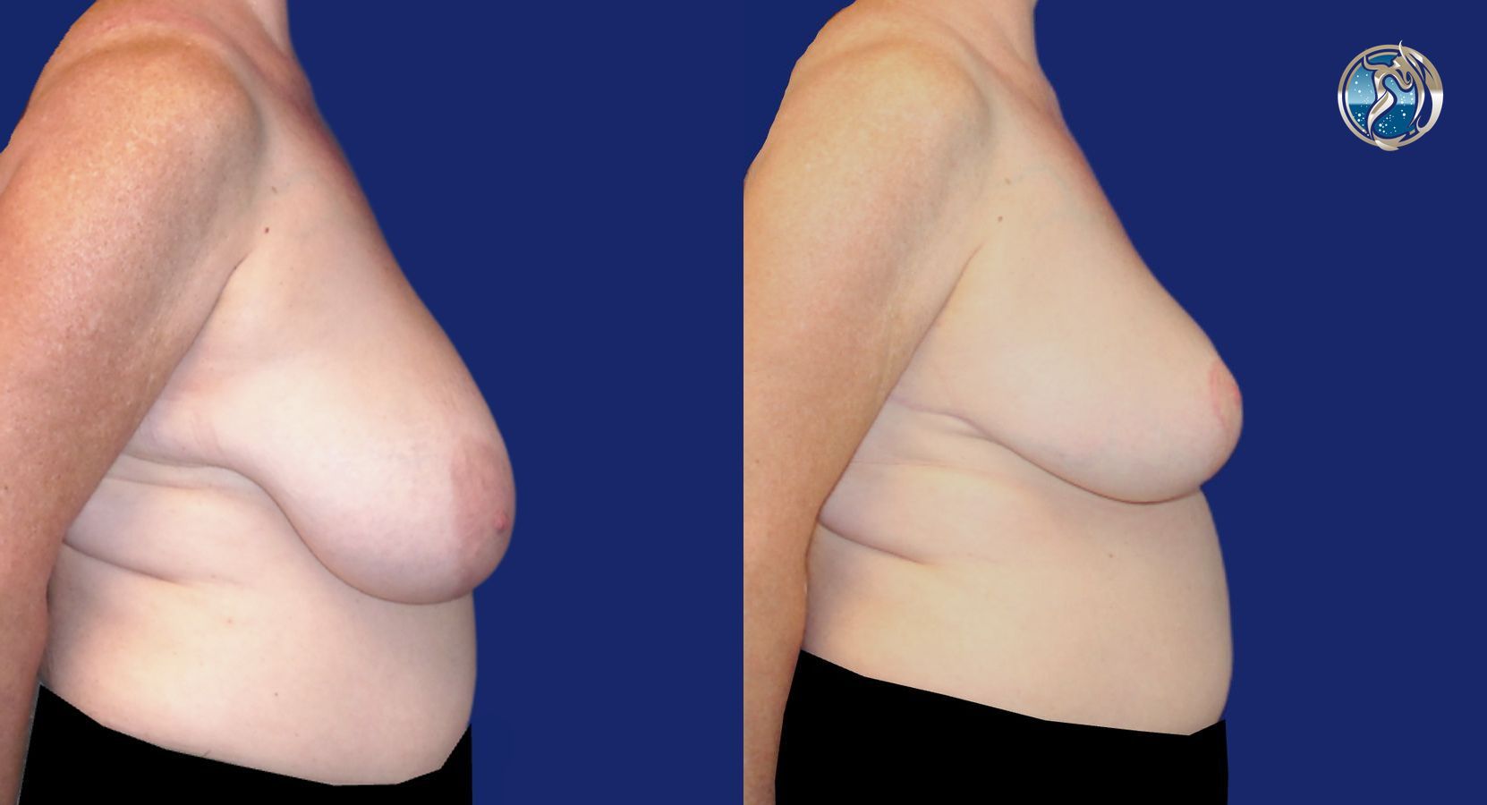 Before and after photo set of Breast Reduction by Dr. Orna Fisher in San Mateo, CA - Angle 4