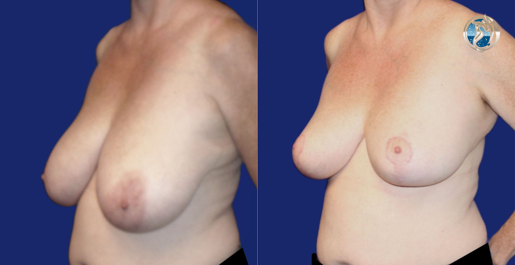 Before and after photo set of Breast Reduction by Dr. Orna Fisher in San Mateo, CA - Angle 2