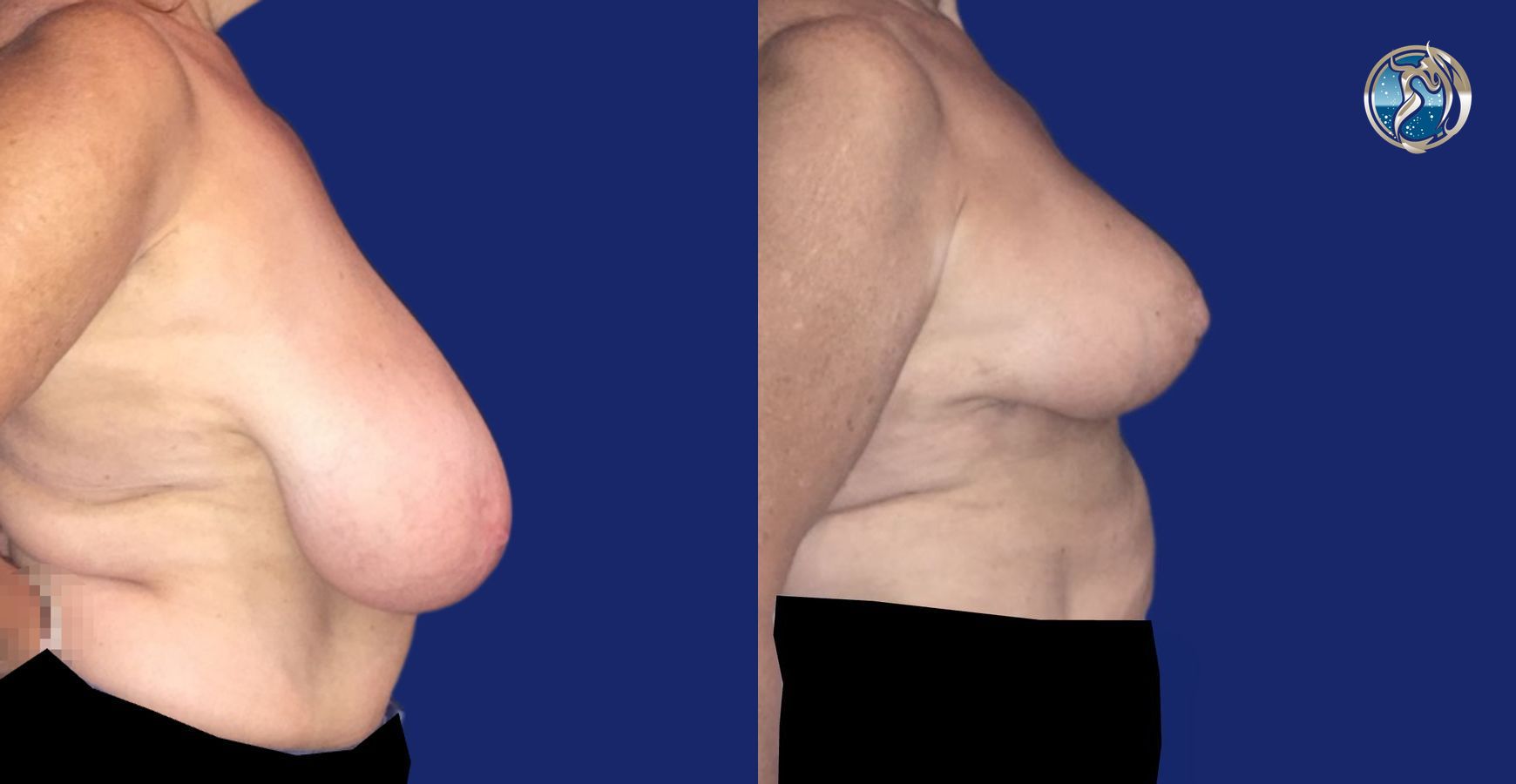 Before and after Breast Reduction case 46110 - Angle 3