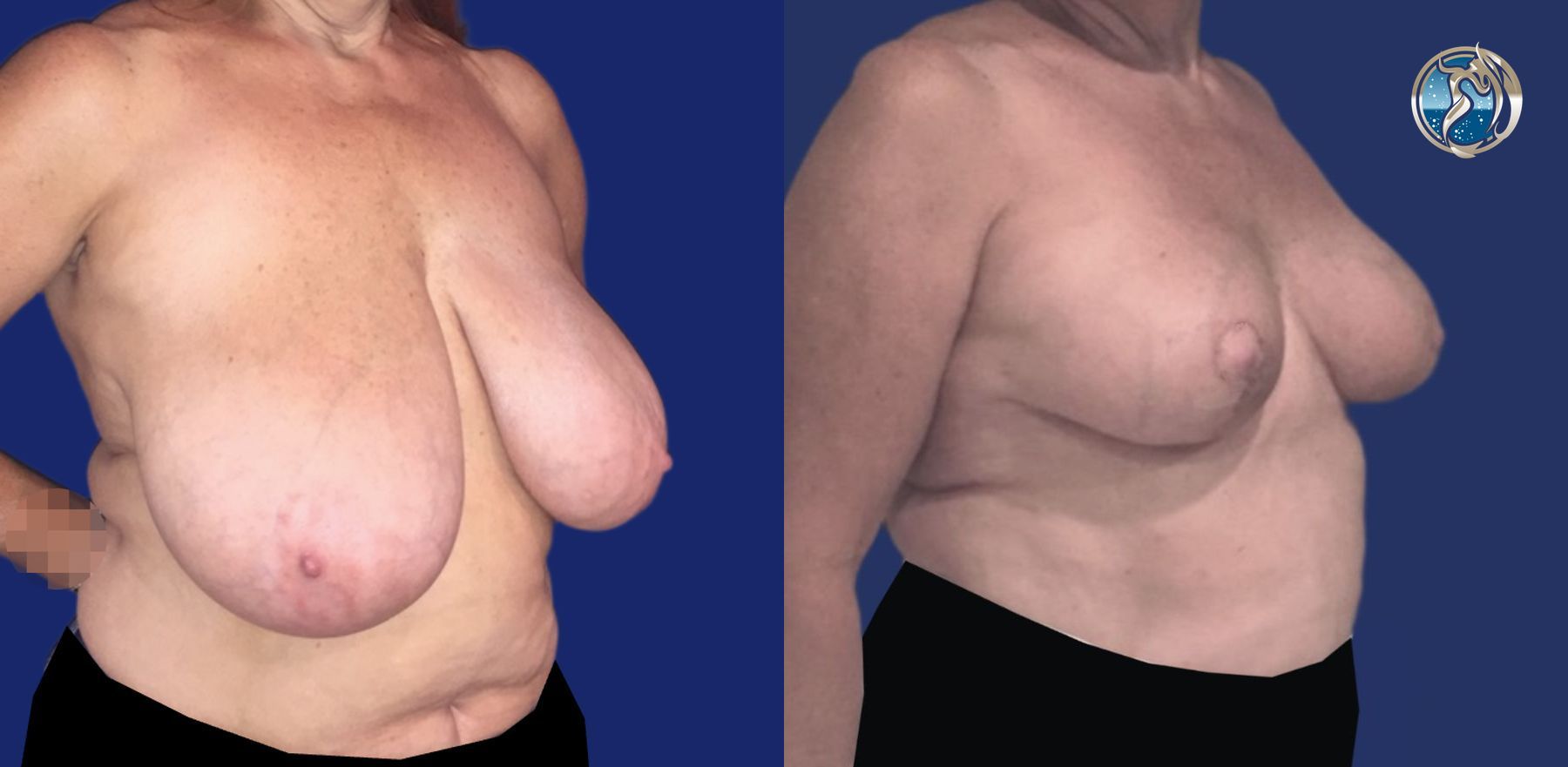 Before and after Breast Reduction case 46110 - Angle 2