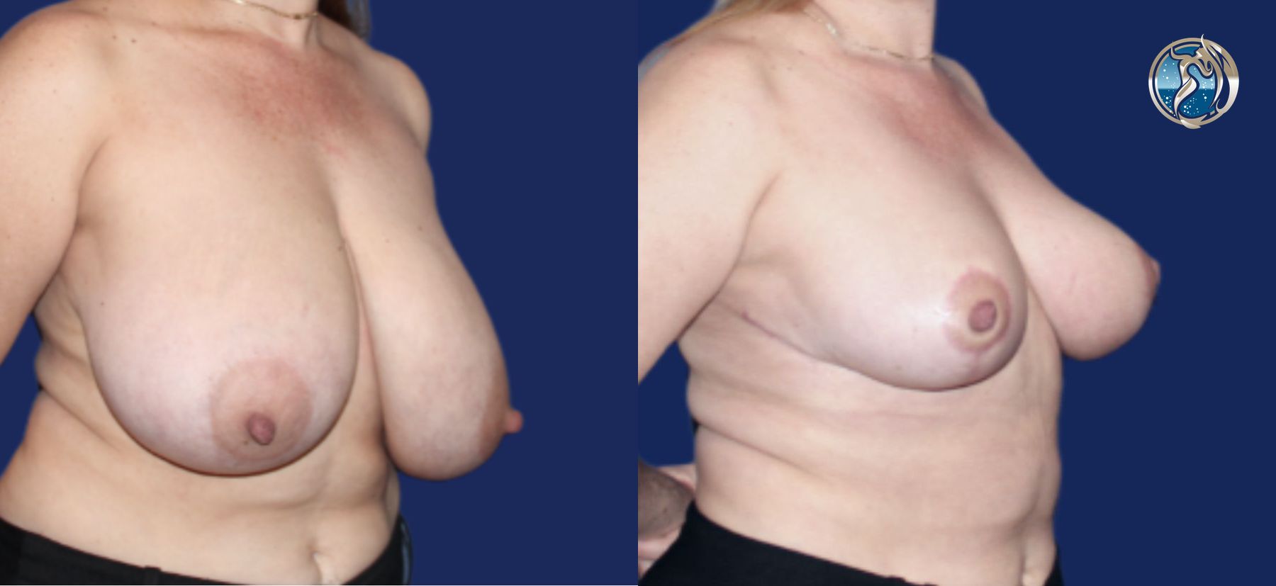 Before and after photo set of Breast Reduction by Dr. Orna Fisher in San Mateo, CA - Angle 2