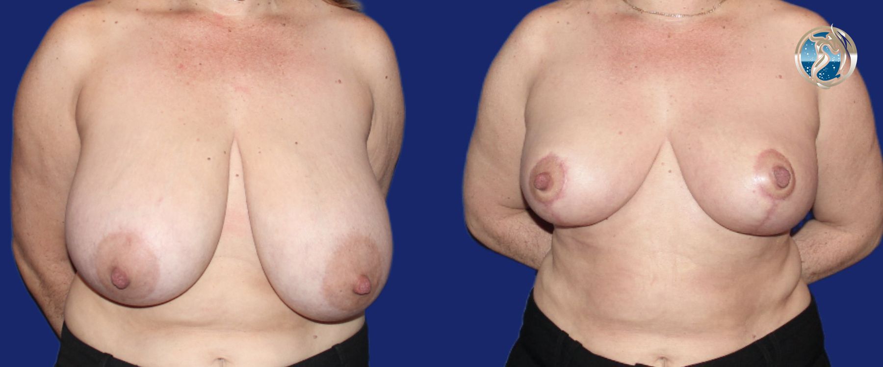 Before and after photo set of Breast Reduction by Dr. Orna Fisher in San Mateo, CA