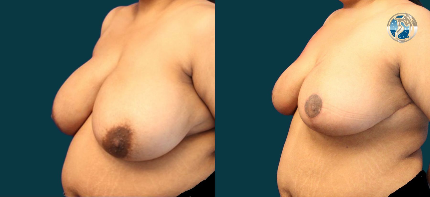 Before and after photo set of Breast Reduction by Dr. Orna Fisher in San Mateo, CA - Angle 2