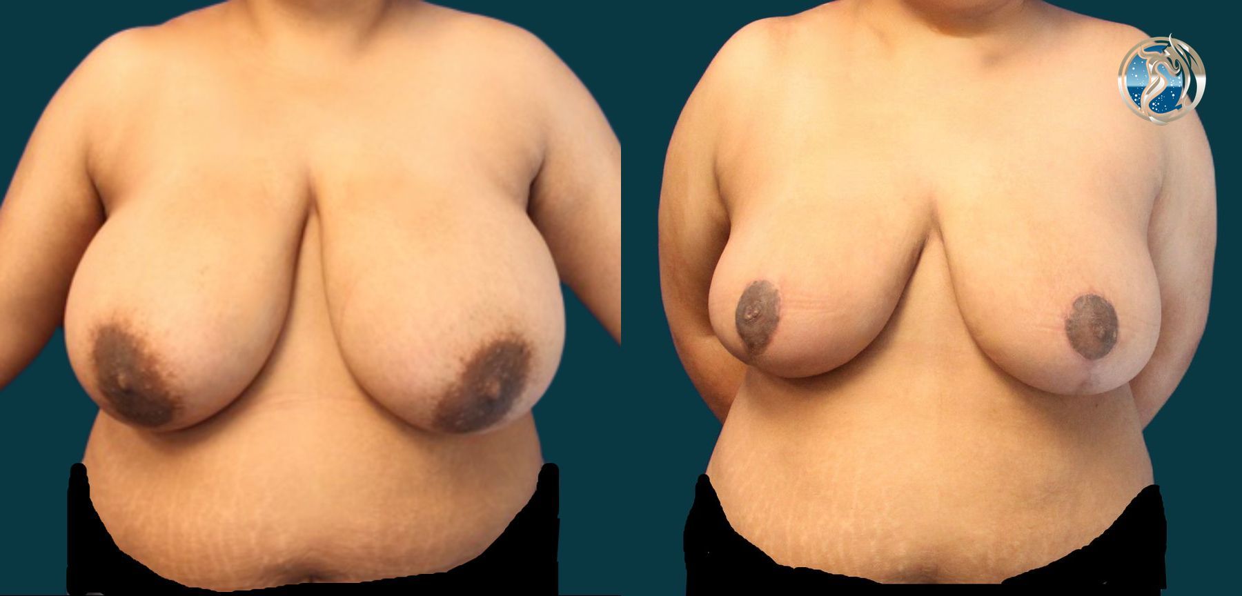 Before and after photo set of Breast Reduction by Dr. Orna Fisher in San Mateo, CA