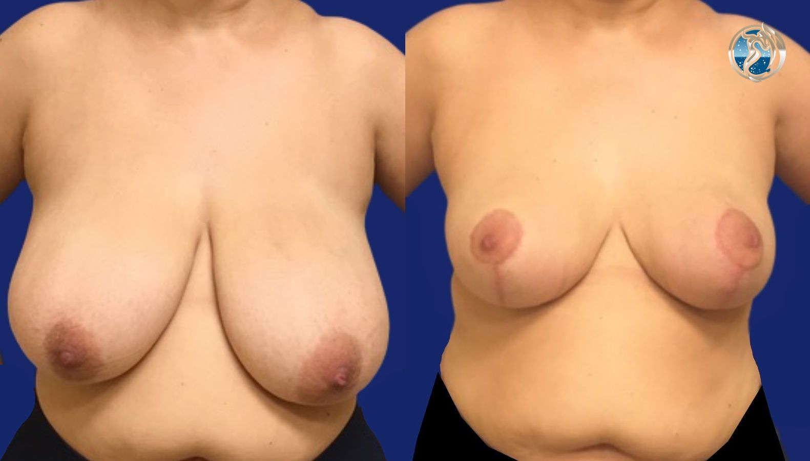 Before and after Breast Reduction case 46106