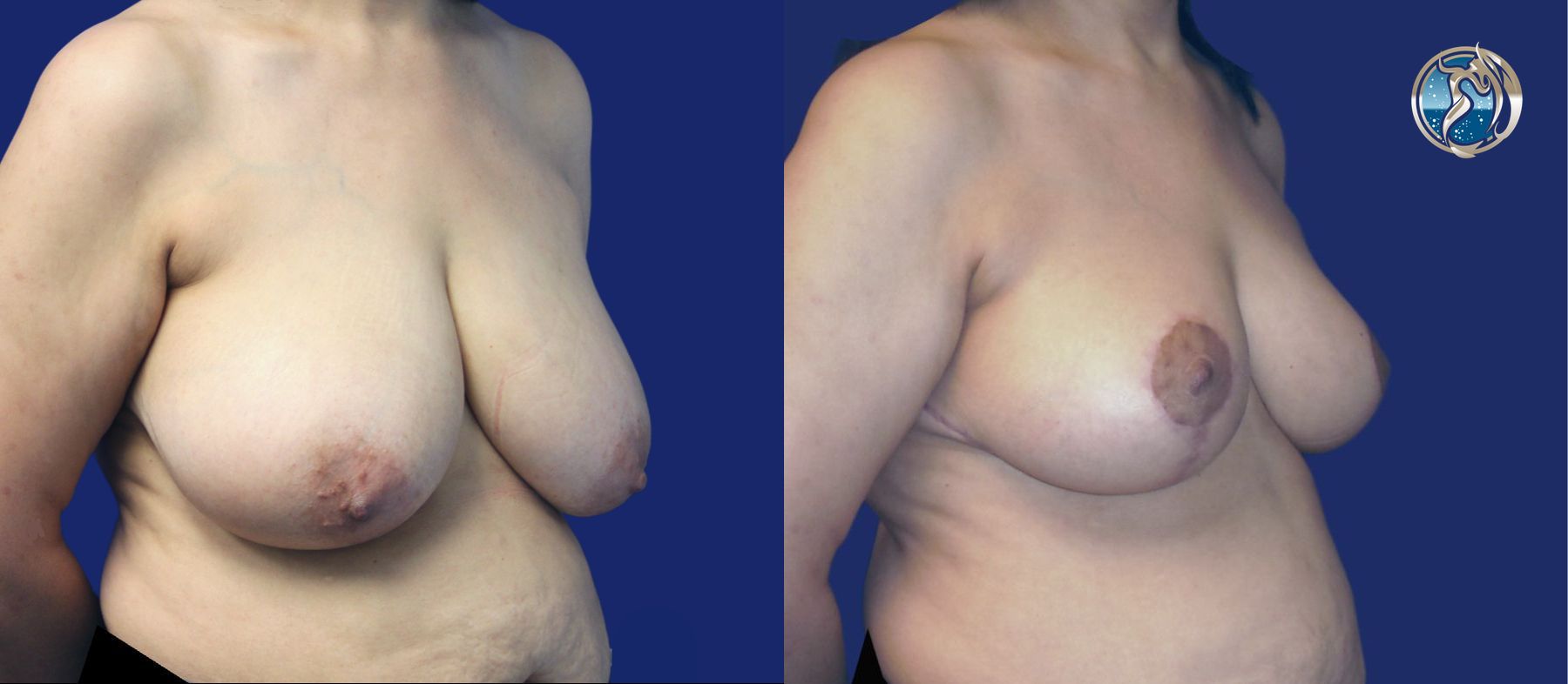 Before and after photo set of Breast Reduction by Dr. Orna Fisher in San Mateo, CA - Angle 4
