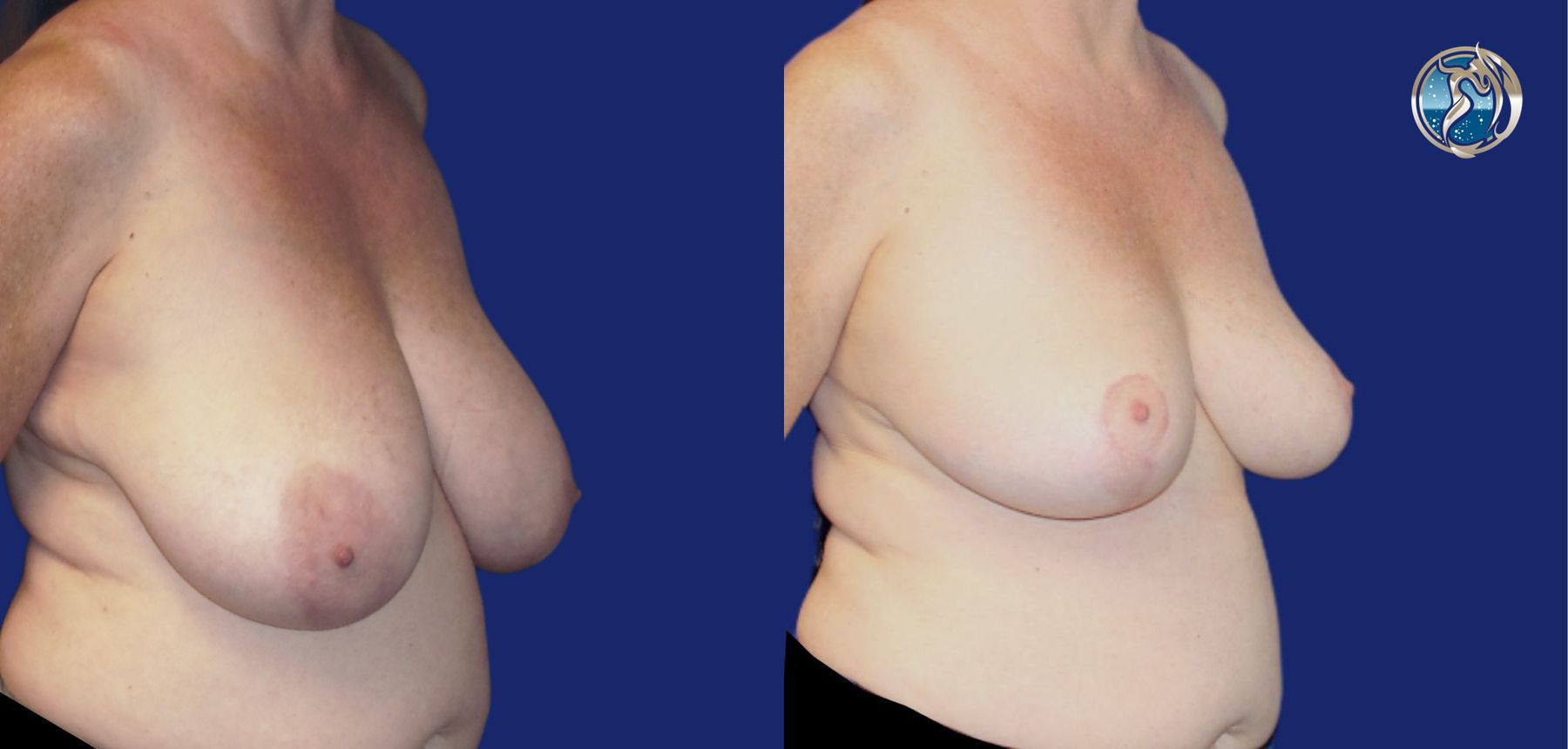 Before and after photo set of Breast Reduction by Dr. Orna Fisher in San Mateo, CA - Angle 3