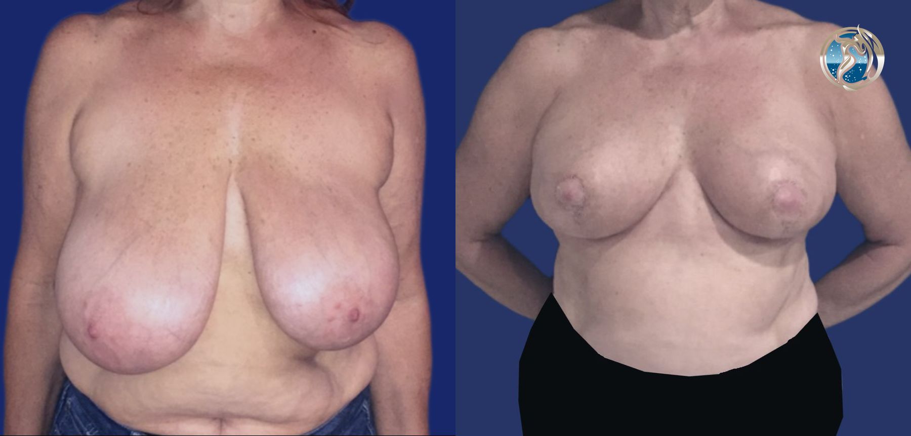 Before and after Breast Reduction case 46110