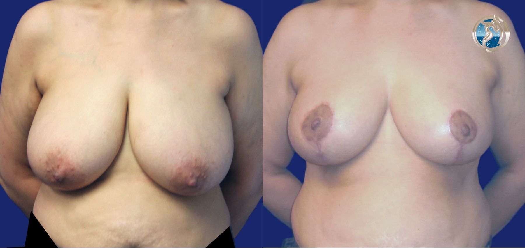 Before and after photo set of Breast Reduction by Dr. Orna Fisher in San Mateo, CA