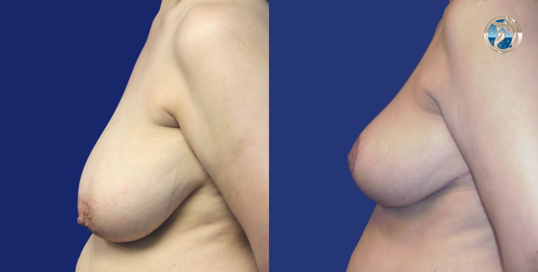 Before and after photo set of Breast Reduction by Dr. Orna Fisher in San Mateo, CA - Angle 3