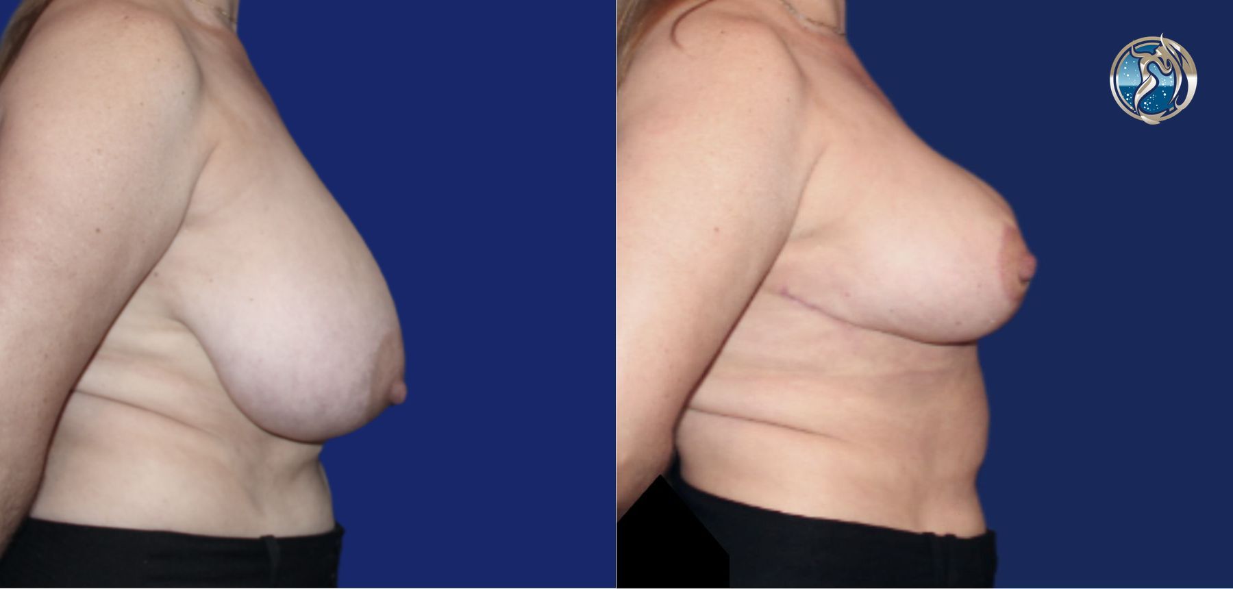 Before and after photo set of Breast Reduction by Dr. Orna Fisher in San Mateo, CA - Angle 3