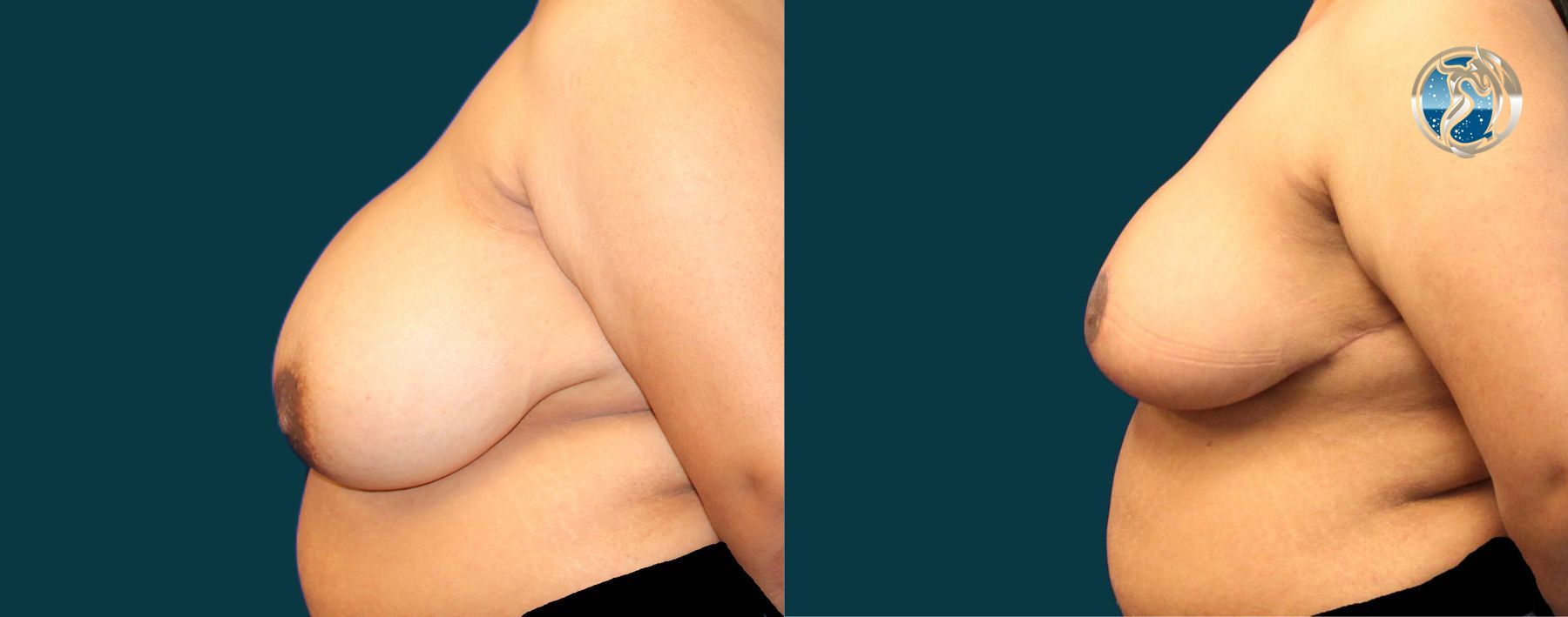 Before and after photo set of Breast Reduction by Dr. Orna Fisher in San Mateo, CA - Angle 3