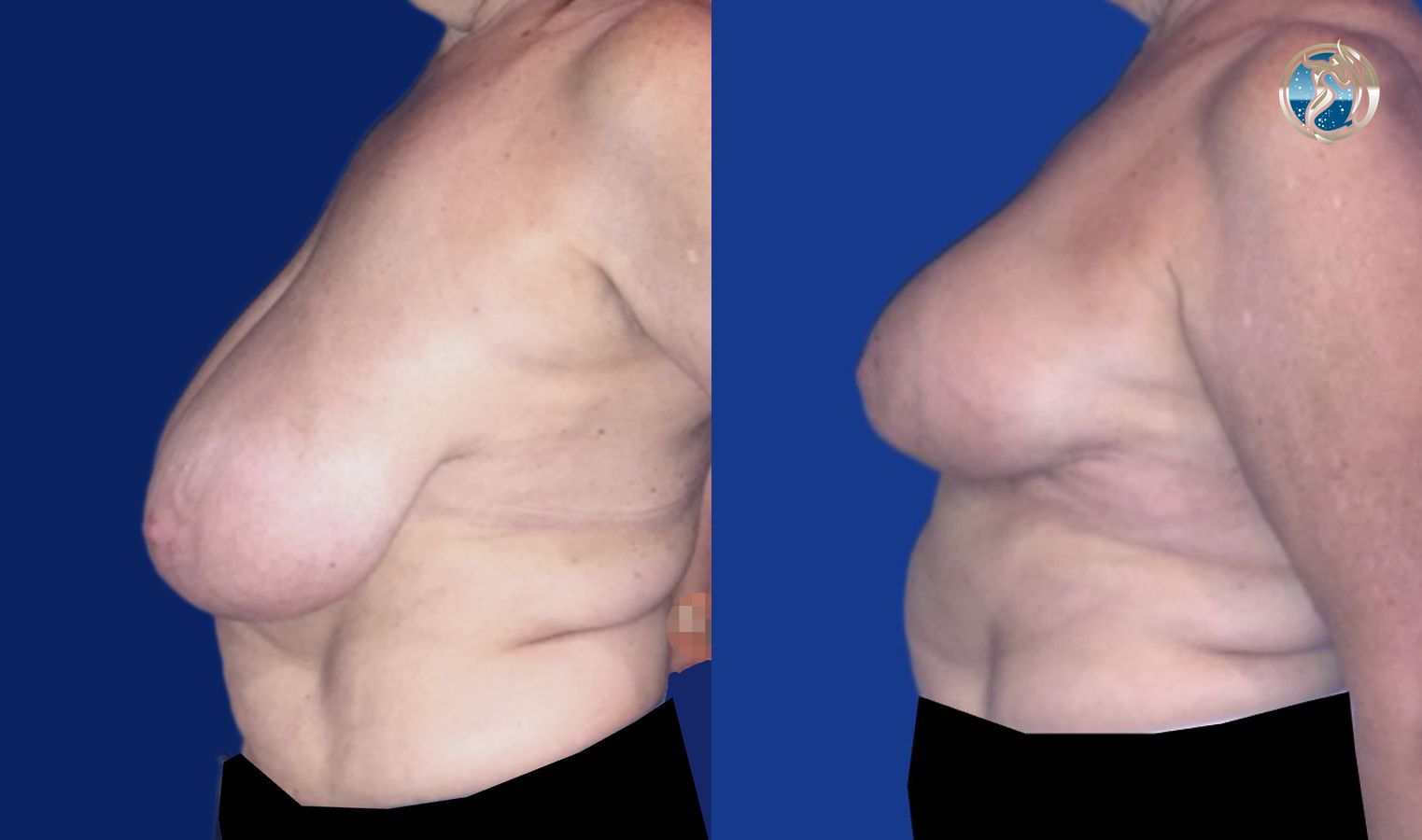Before and after Breast Reduction case 46110 - Angle 4