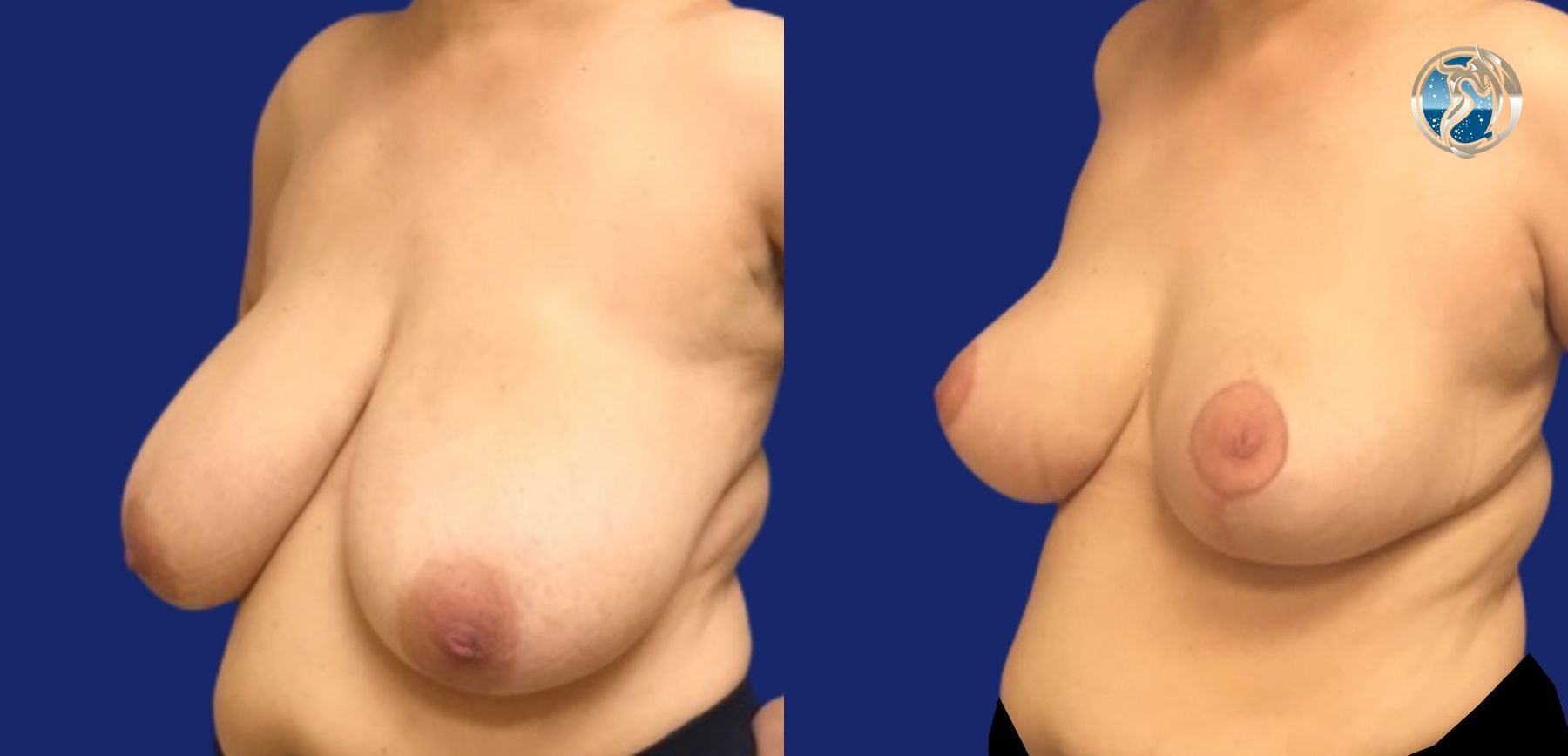 Before and after Breast Reduction case 46106 - Angle 2