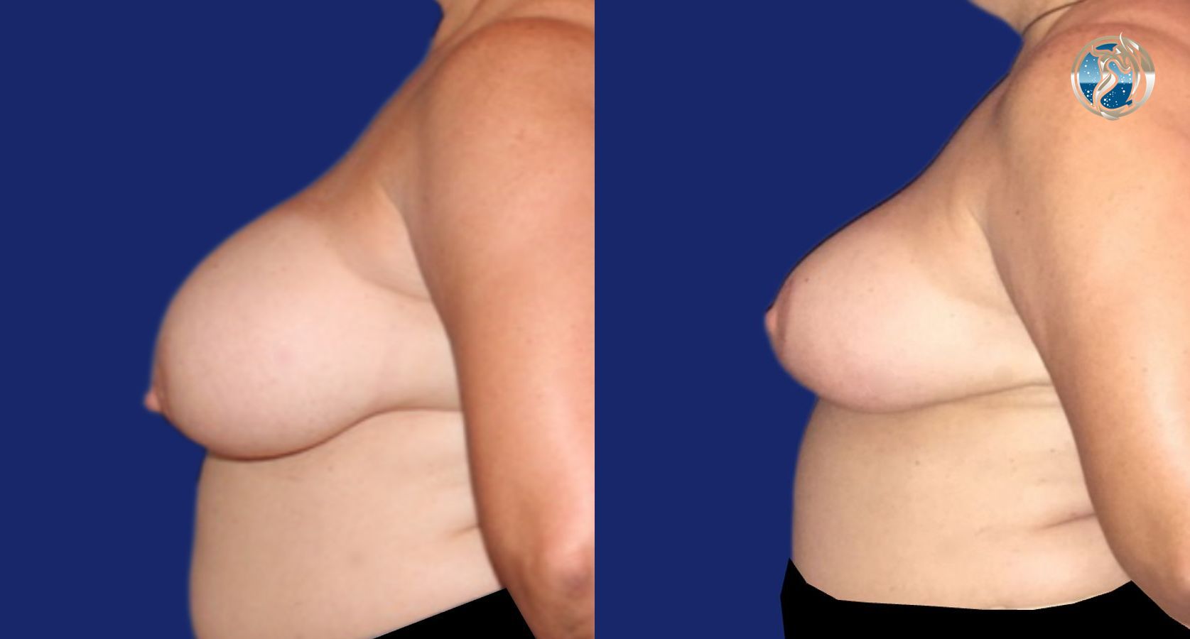 Before and after Breast Reduction case 46063 - Angle 4