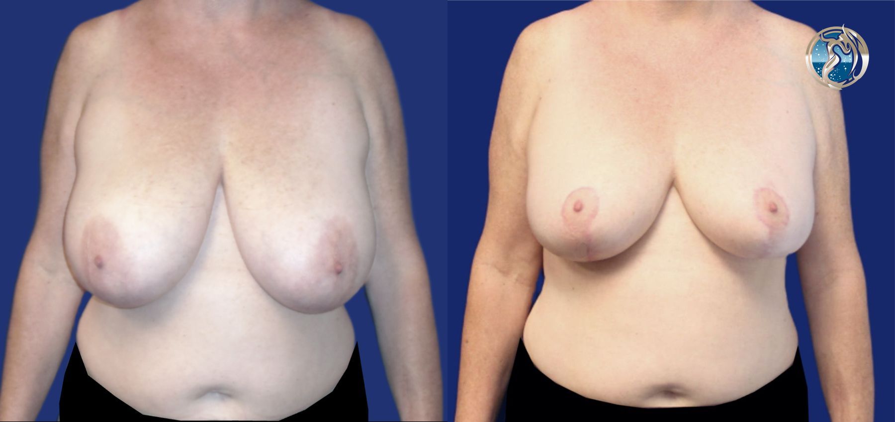 Before and after photo set of Breast Reduction by Dr. Orna Fisher in San Mateo, CA