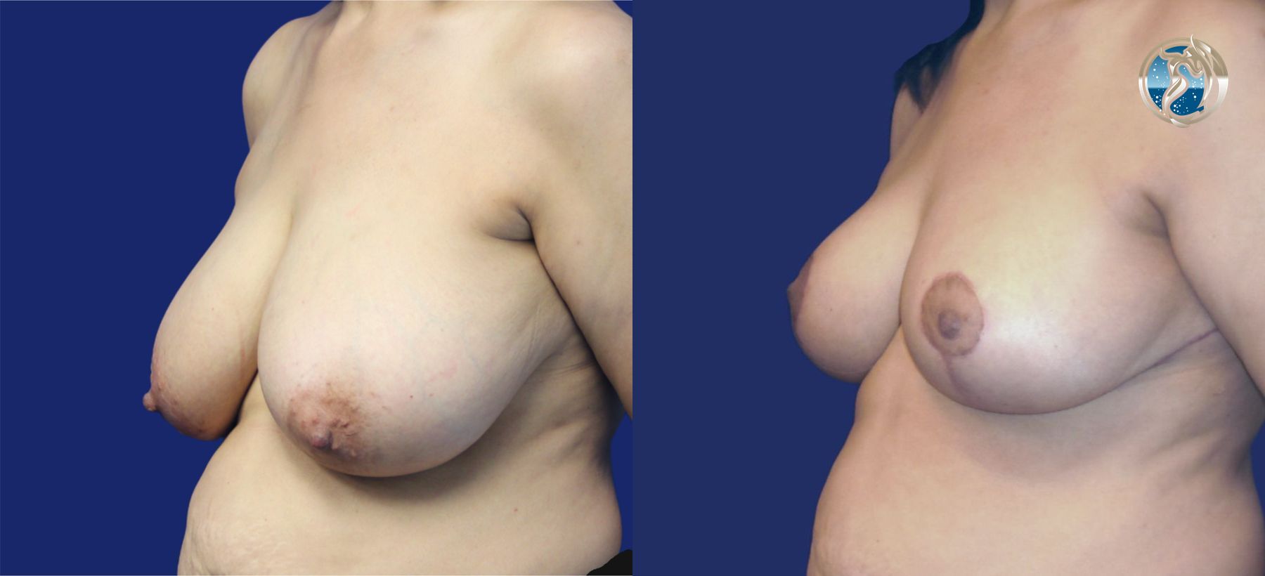 Before and after photo set of Breast Reduction by Dr. Orna Fisher in San Mateo, CA - Angle 2