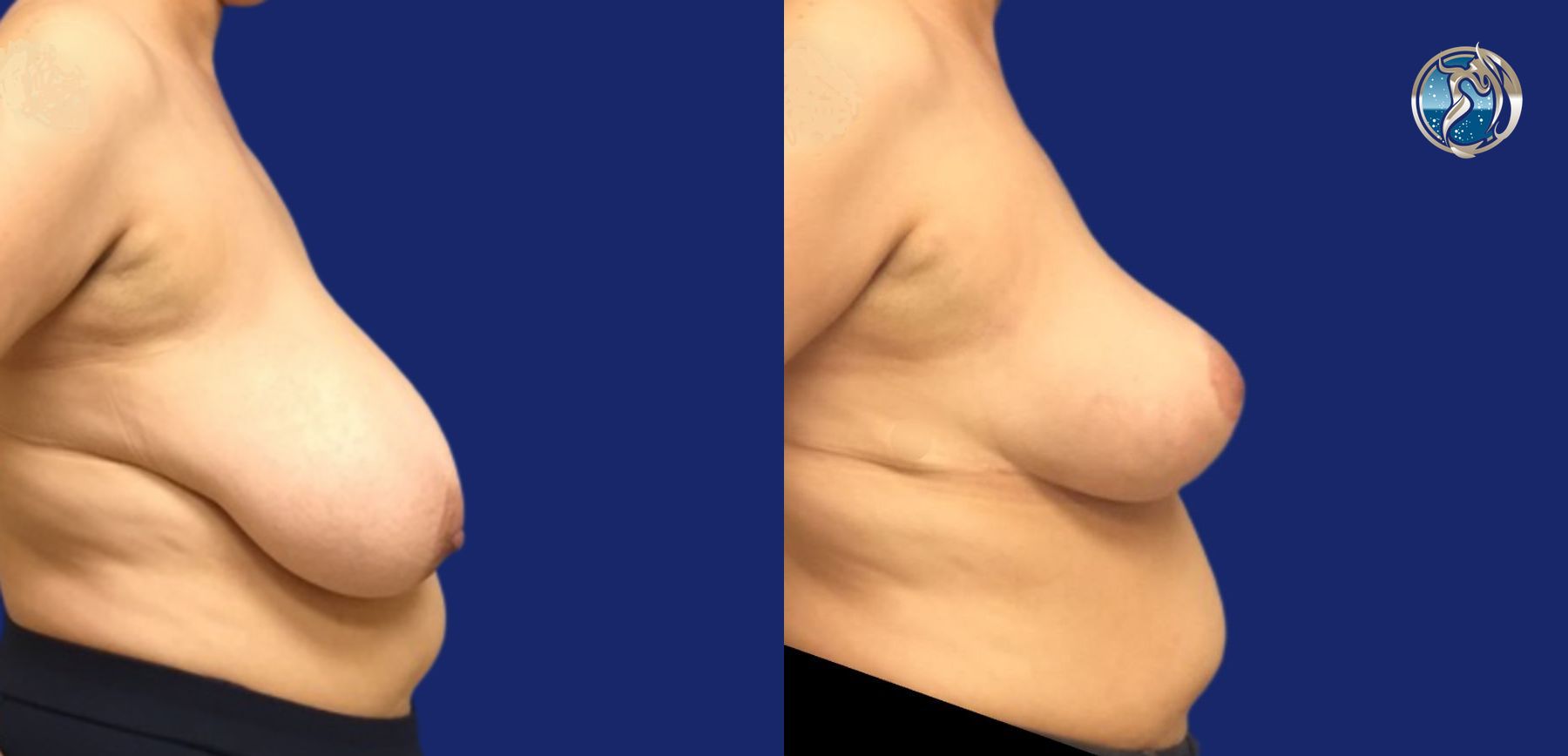 Before and after Breast Reduction case 46106 - Angle 4