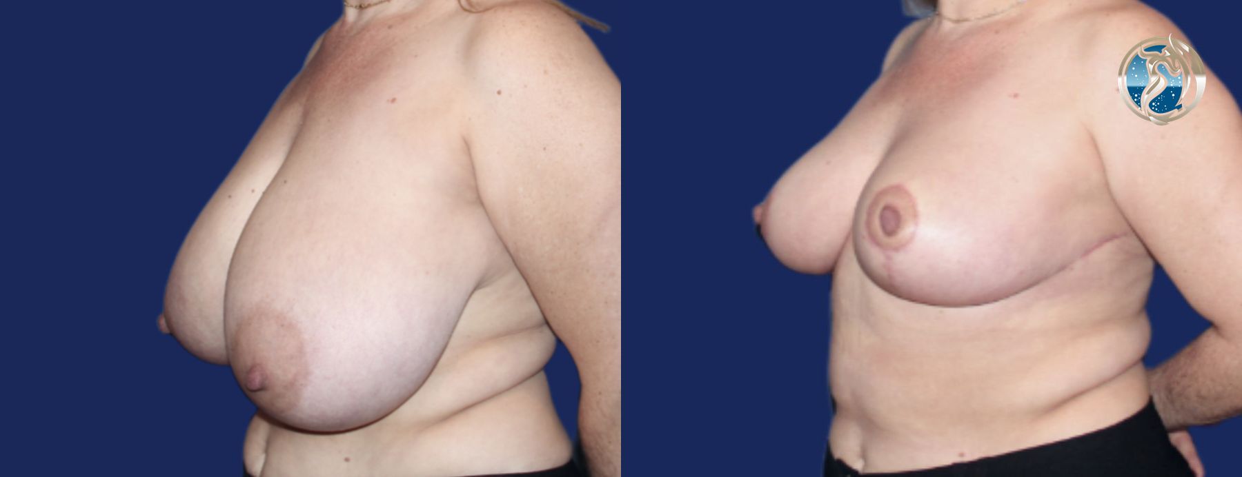 Before and after photo set of Breast Reduction by Dr. Orna Fisher in San Mateo, CA - Angle 4