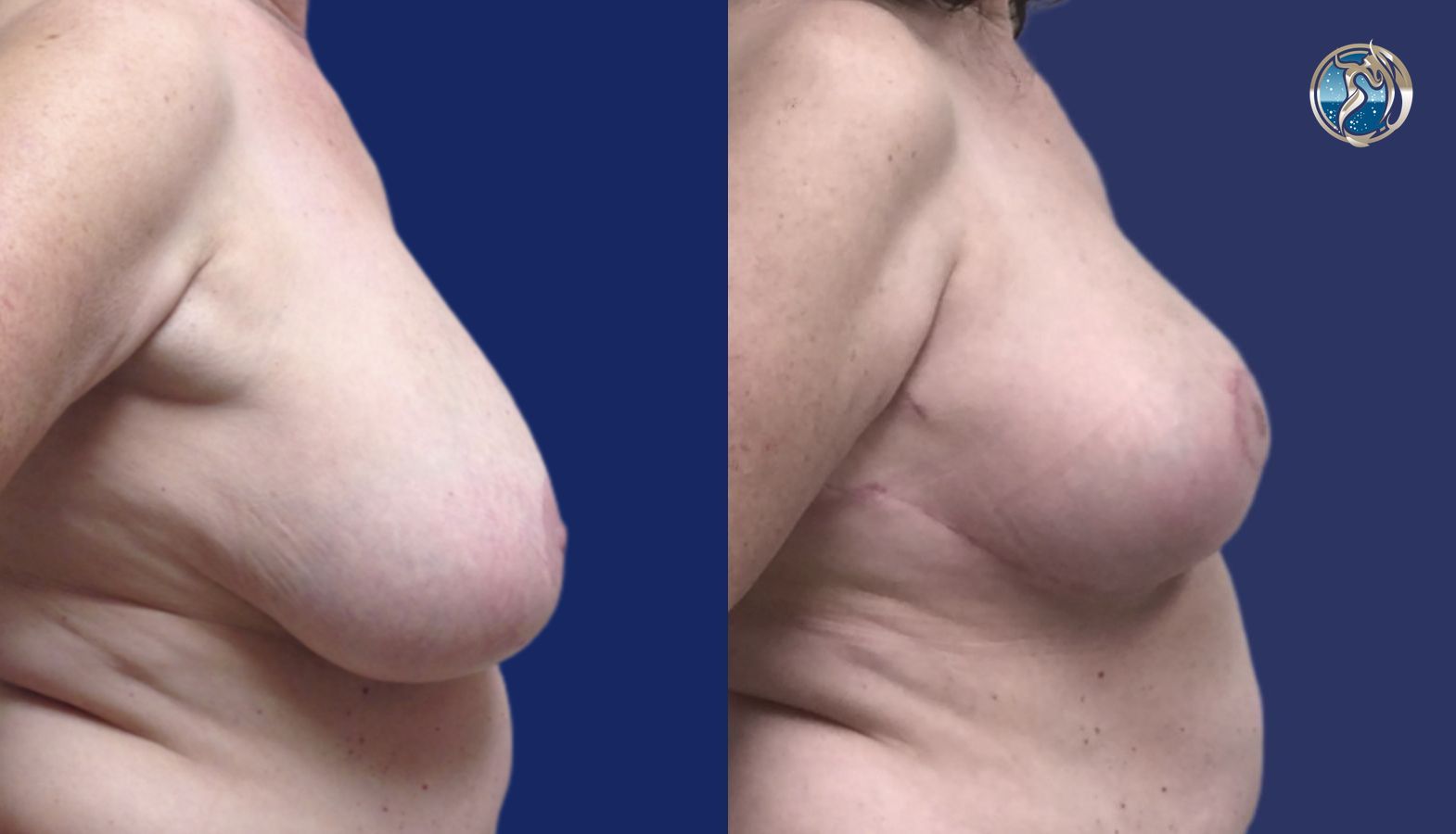 Before and after Accessory Axillary Breast Tissue Excision case 46044 - Angle 3