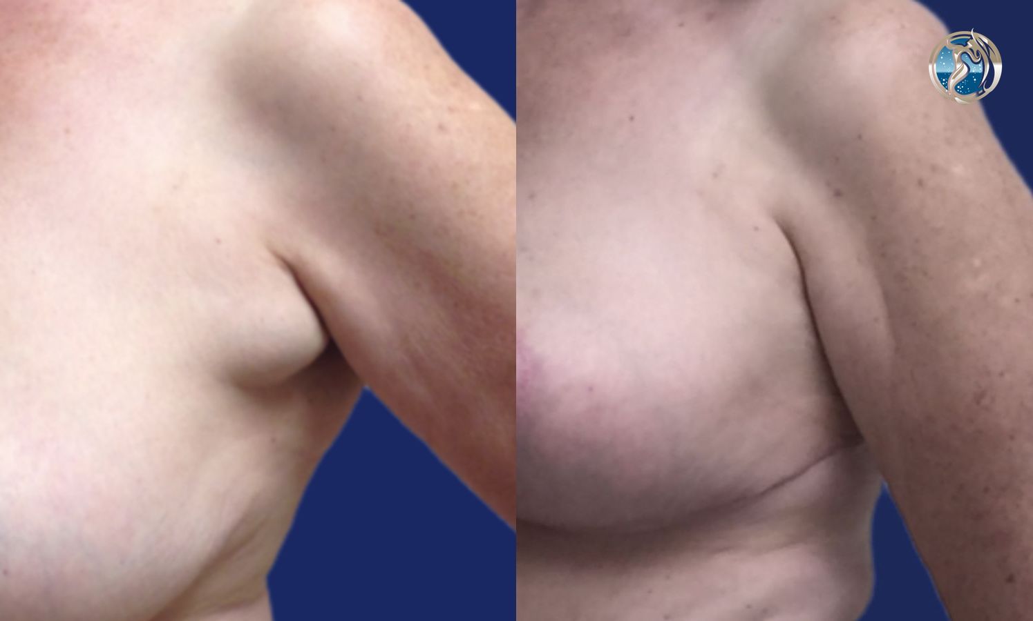 Before and after Accessory Axillary Breast Tissue Excision case 46044 - Angle 4