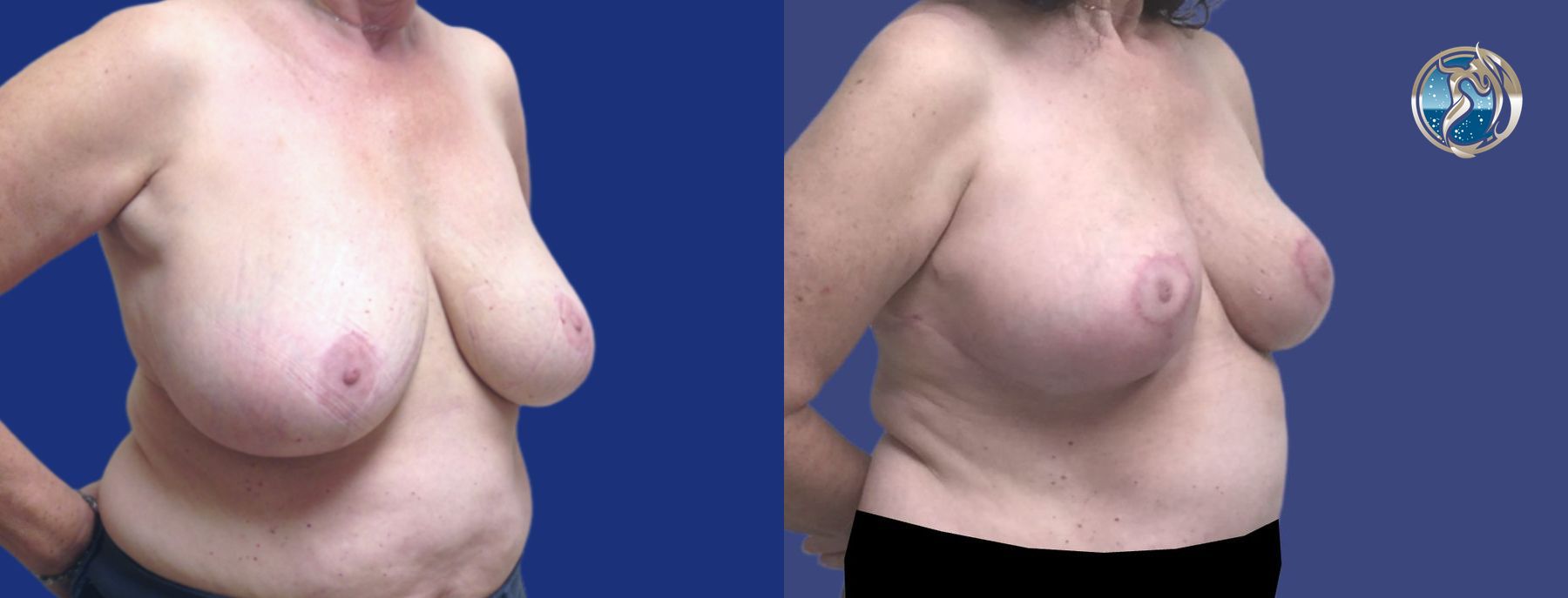 Before and after Accessory Axillary Breast Tissue Excision case 46044 - Angle 2