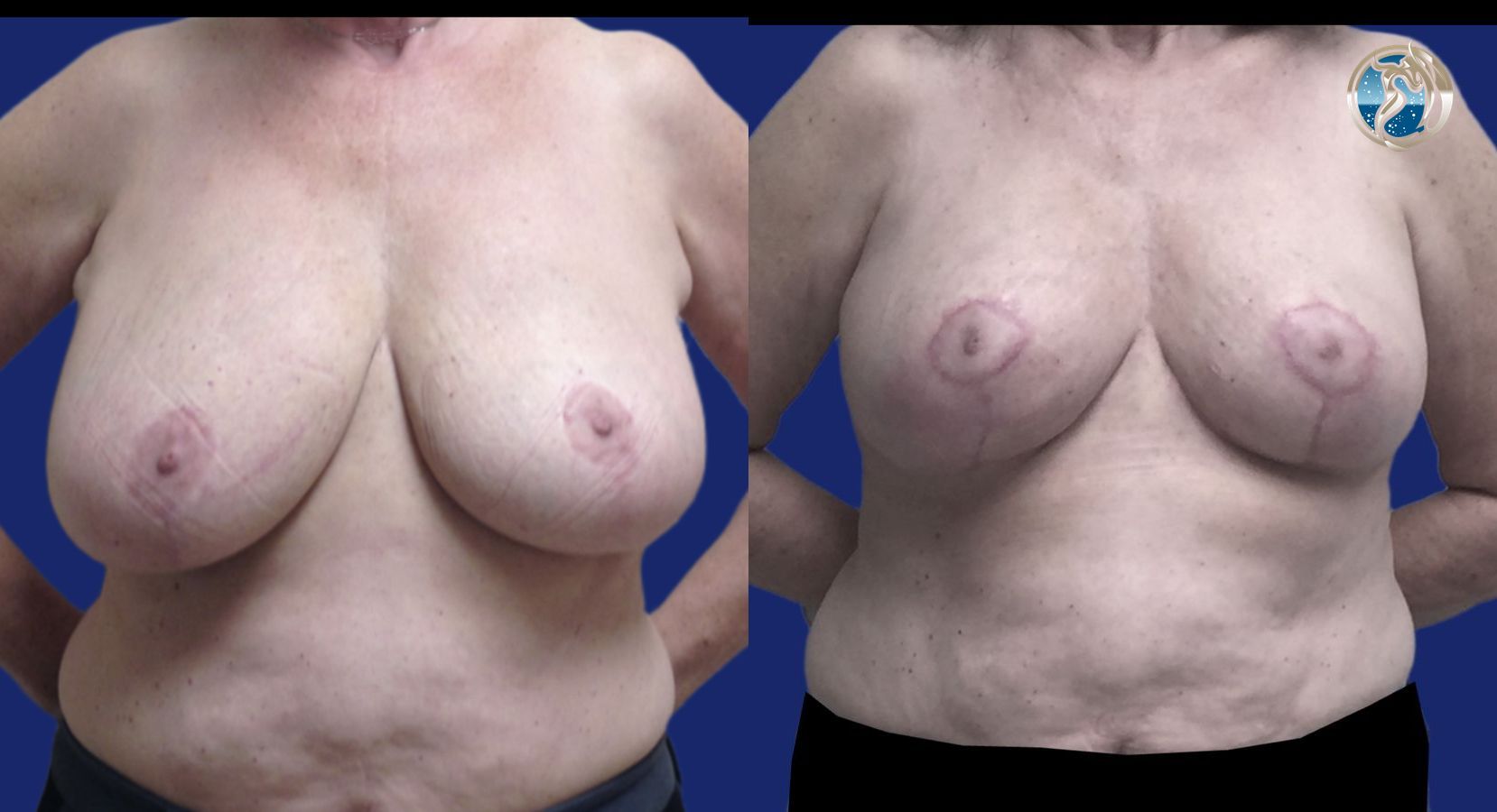 Before and after Accessory Axillary Breast Tissue Excision case 46044