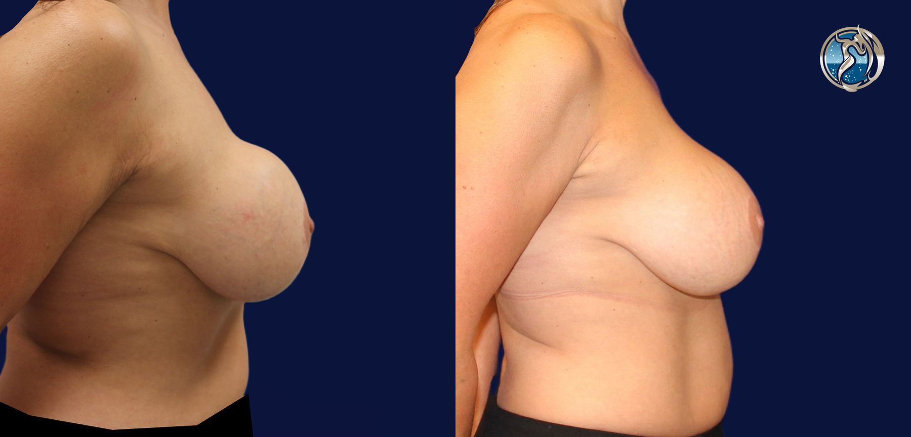 Before and after Breast Revision Surgery case 45733 - Angle 3