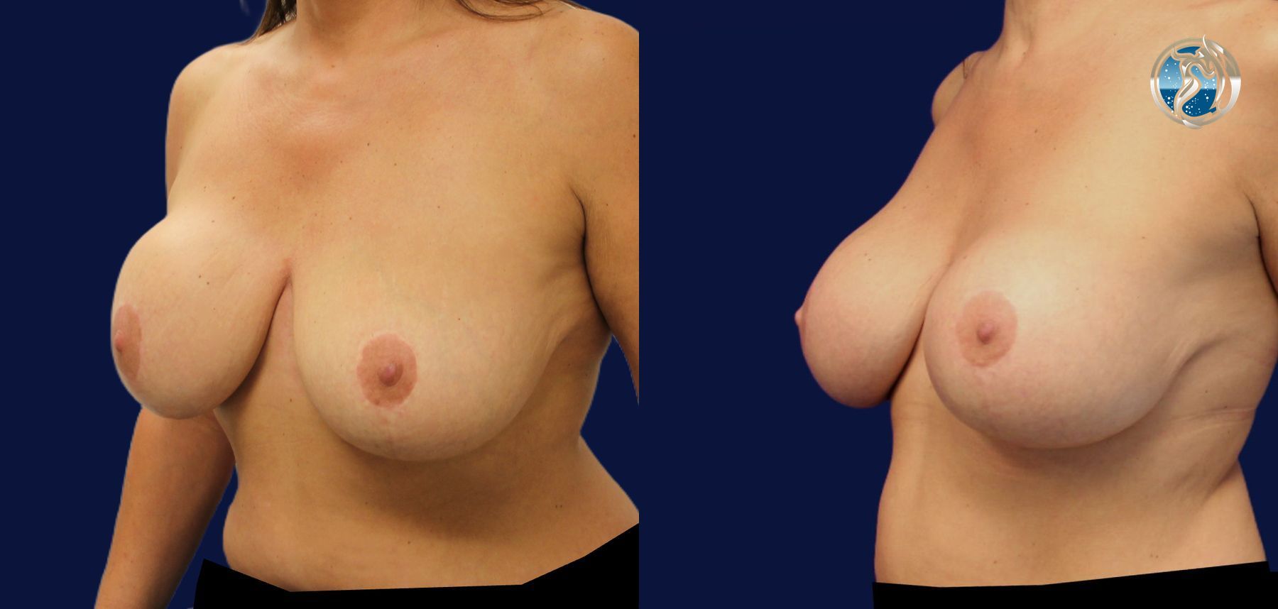 Before and after Breast Revision Surgery case 45733 - Angle 2