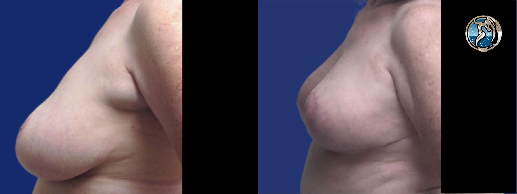Before and after Accessory Axillary Breast Tissue Excision case 46044 - Angle 5