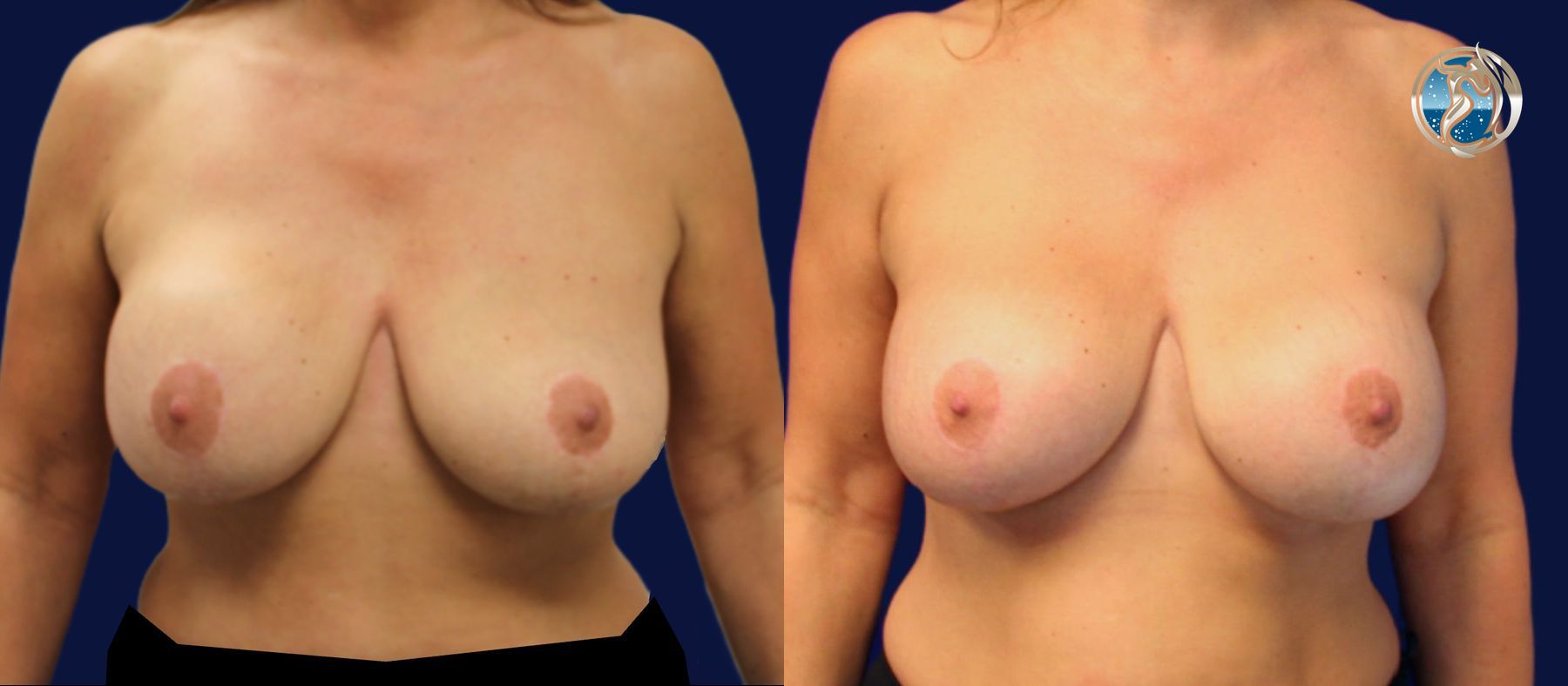 Before and after Breast Revision Surgery case 45733
