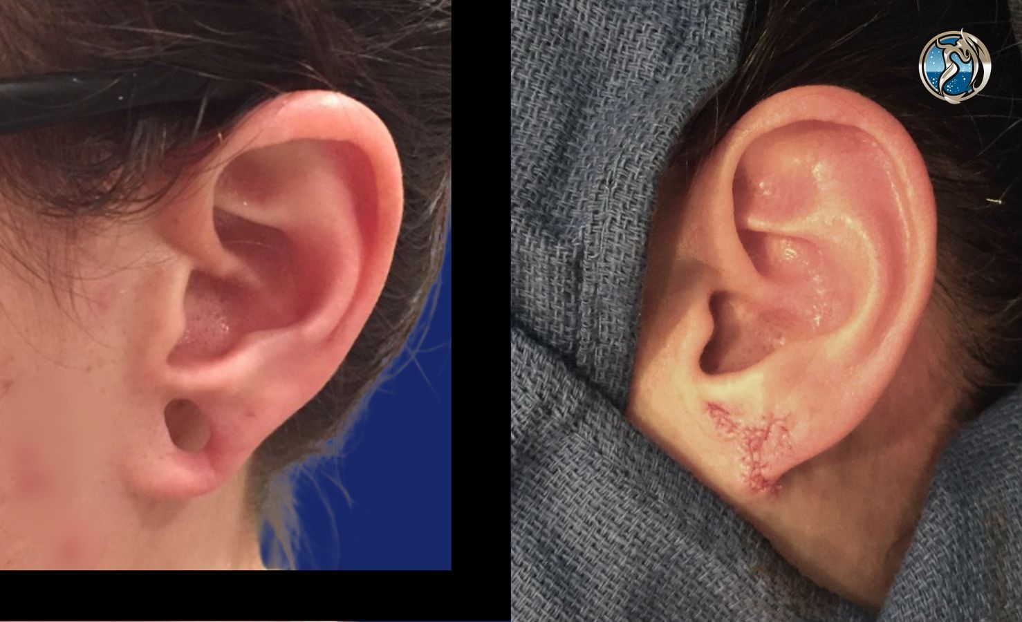 Before and after photo set of Earlobe Repair by Dr. Orna Fisher in San Mateo, CA - Angle 2