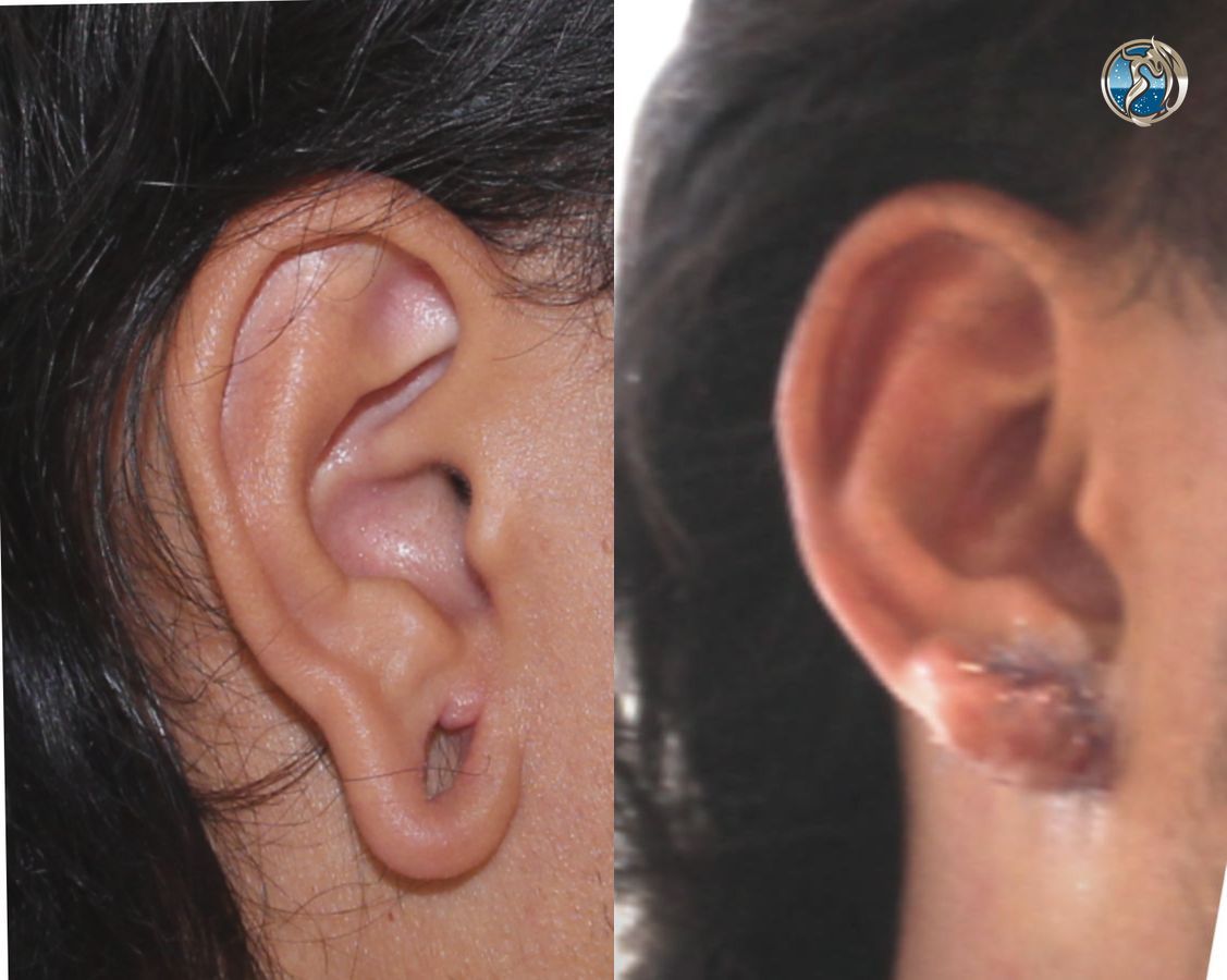 Before and after Ear Lobe Repair case 46036