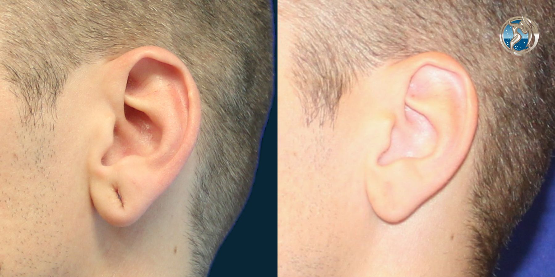 Before and after photo set of Earlobe Repair by Dr. Orna Fisher in San Mateo, CA