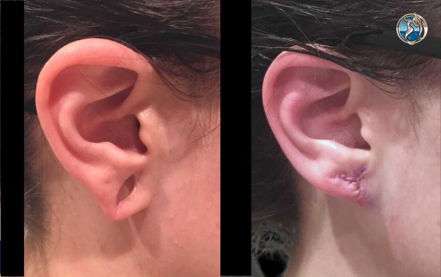 Before and after photo set of Earlobe Repair by Dr. Orna Fisher in San Mateo, CA