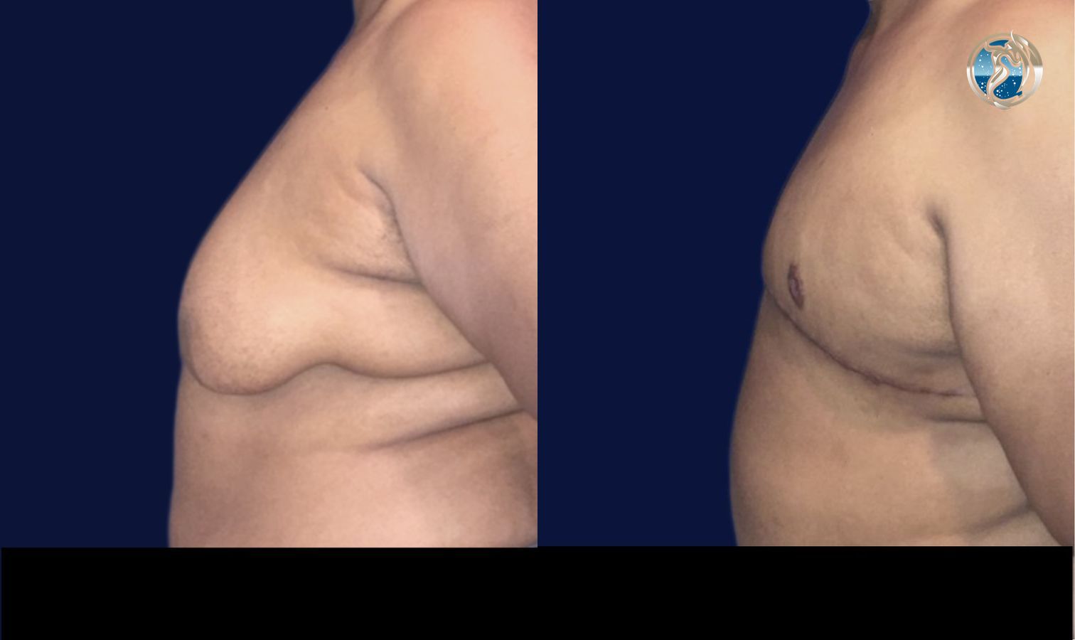 Before and after FTM Top Surgery case 46070 - Angle 2