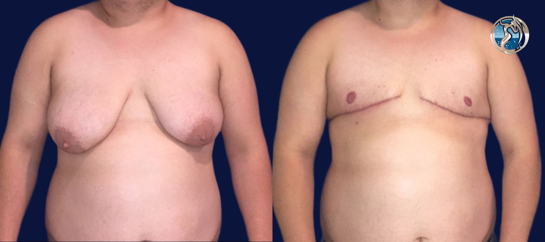 Before and after photo set of FTM Top Surgery by Dr. Orna Fisher in San Mateo, CA