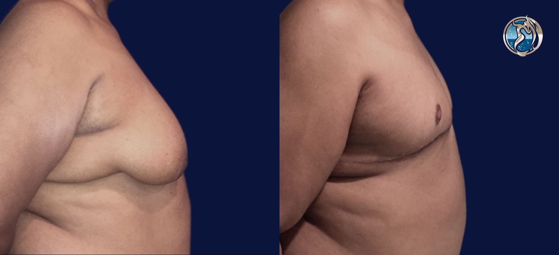 Before and after FTM Top Surgery case 46070 - Angle 4
