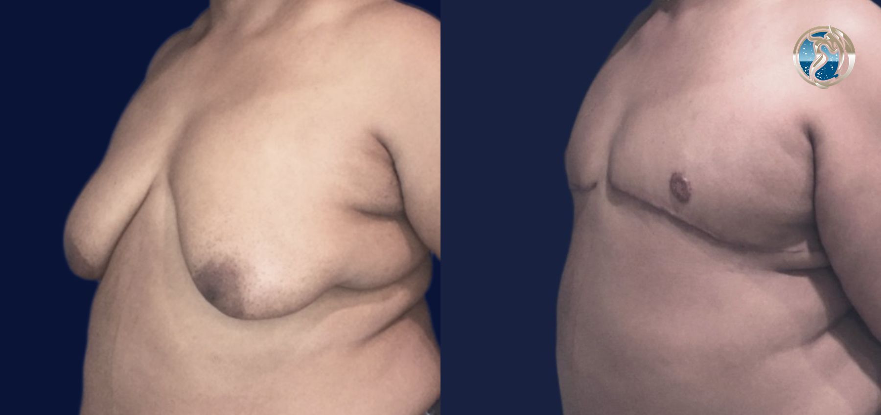 Before and after FTM Top Surgery case 46070 - Angle 3