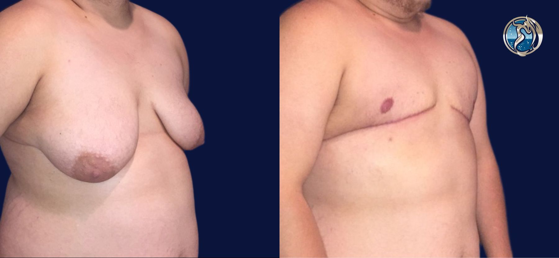 Before and after photo set of FTM Top Surgery by Dr. Orna Fisher in San Mateo, CA - Angle 2