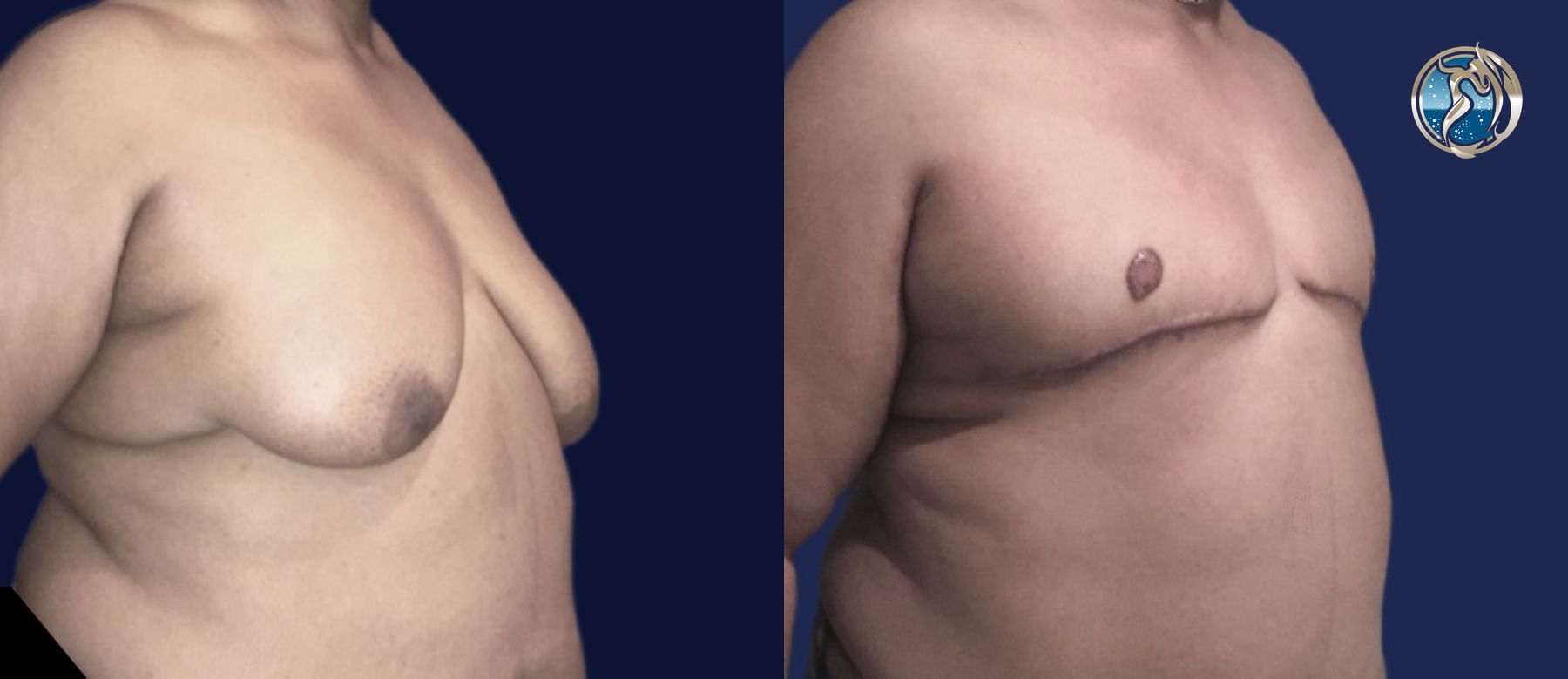 Before and after FTM Top Surgery case 46070 - Angle 5