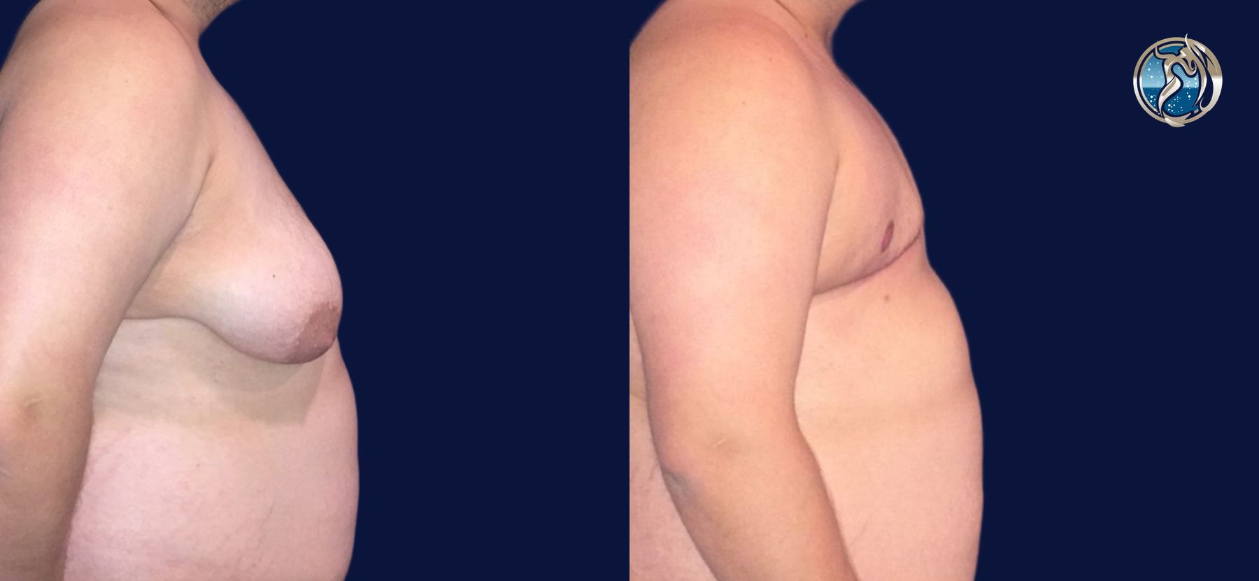 Before and after photo set of FTM Top Surgery by Dr. Orna Fisher in San Mateo, CA - Angle 3
