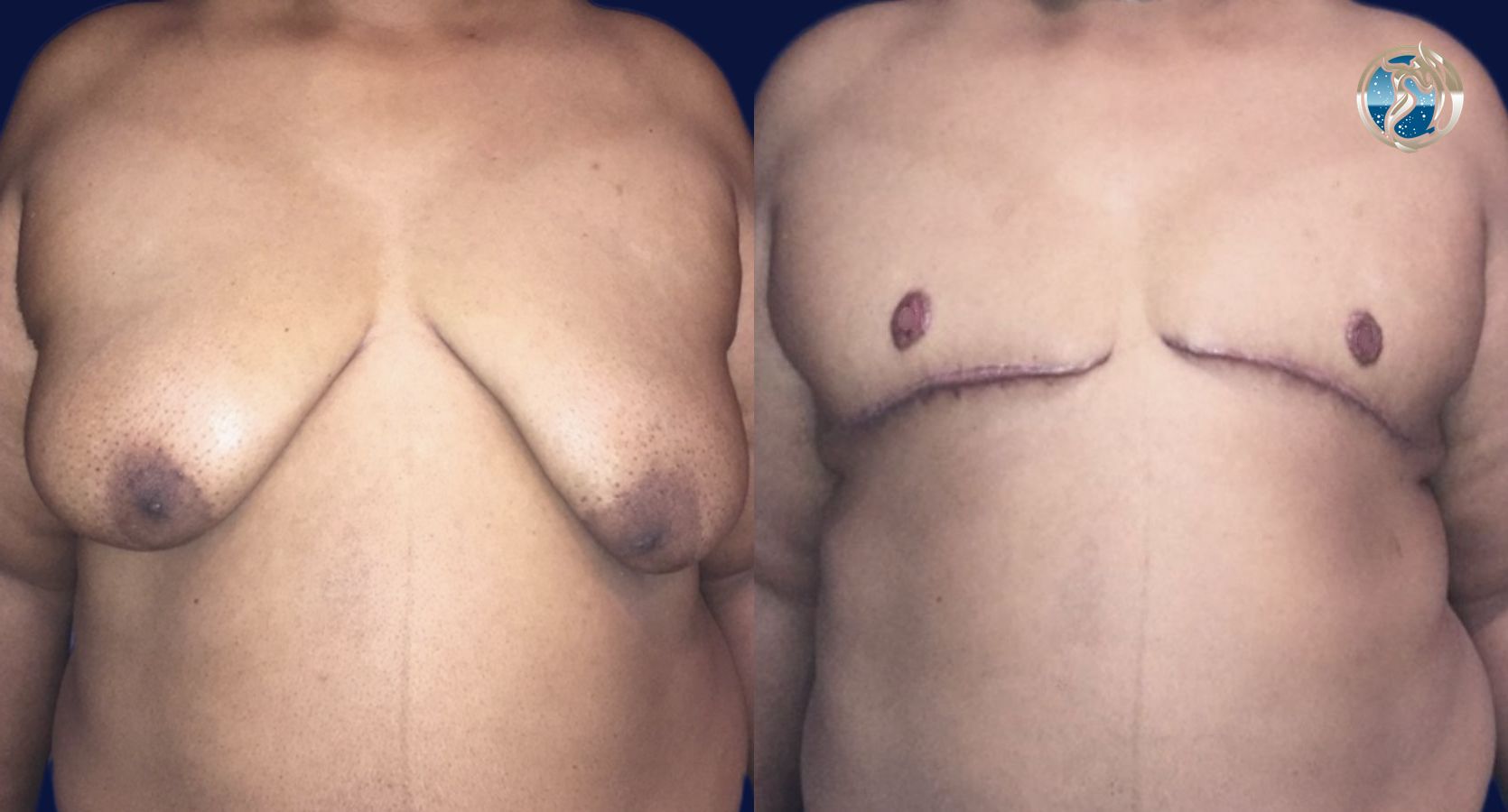Before and after FTM Top Surgery case 46070
