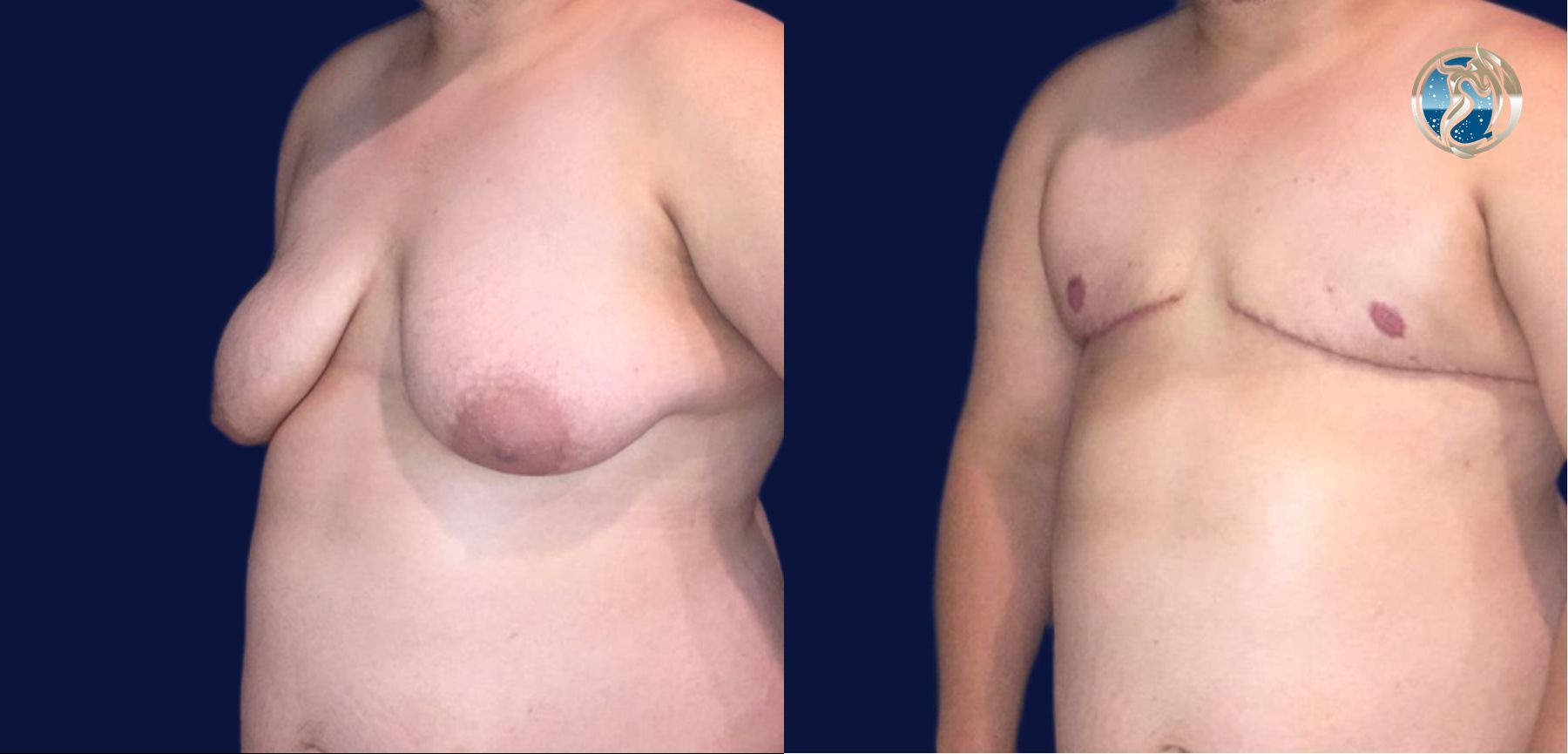 Before and after photo set of FTM Top Surgery by Dr. Orna Fisher in San Mateo, CA - Angle 4