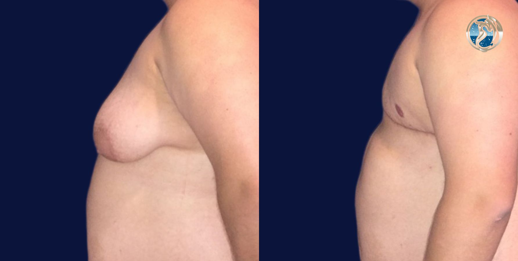 Before and after photo set of FTM Top Surgery by Dr. Orna Fisher in San Mateo, CA - Angle 5